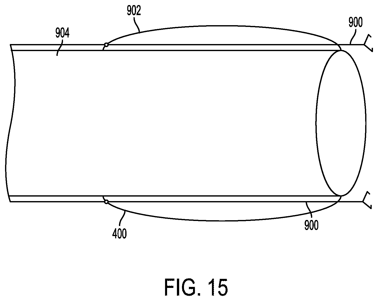 Patent US12403026 Figure 17 – Valve with docking station for gastrointestinal balloon
