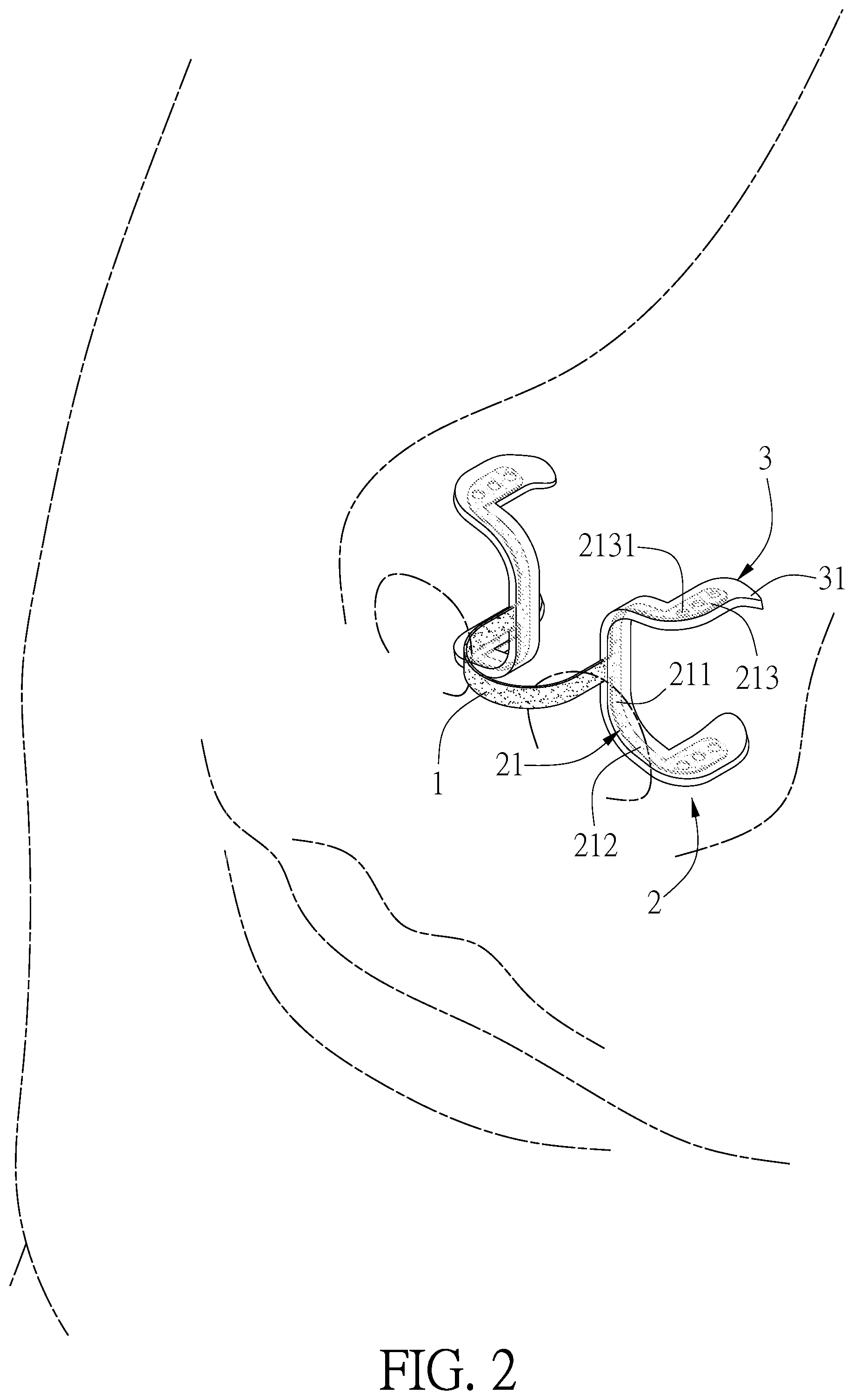 Patent US12403032 Figure 2 – Nasal dilator