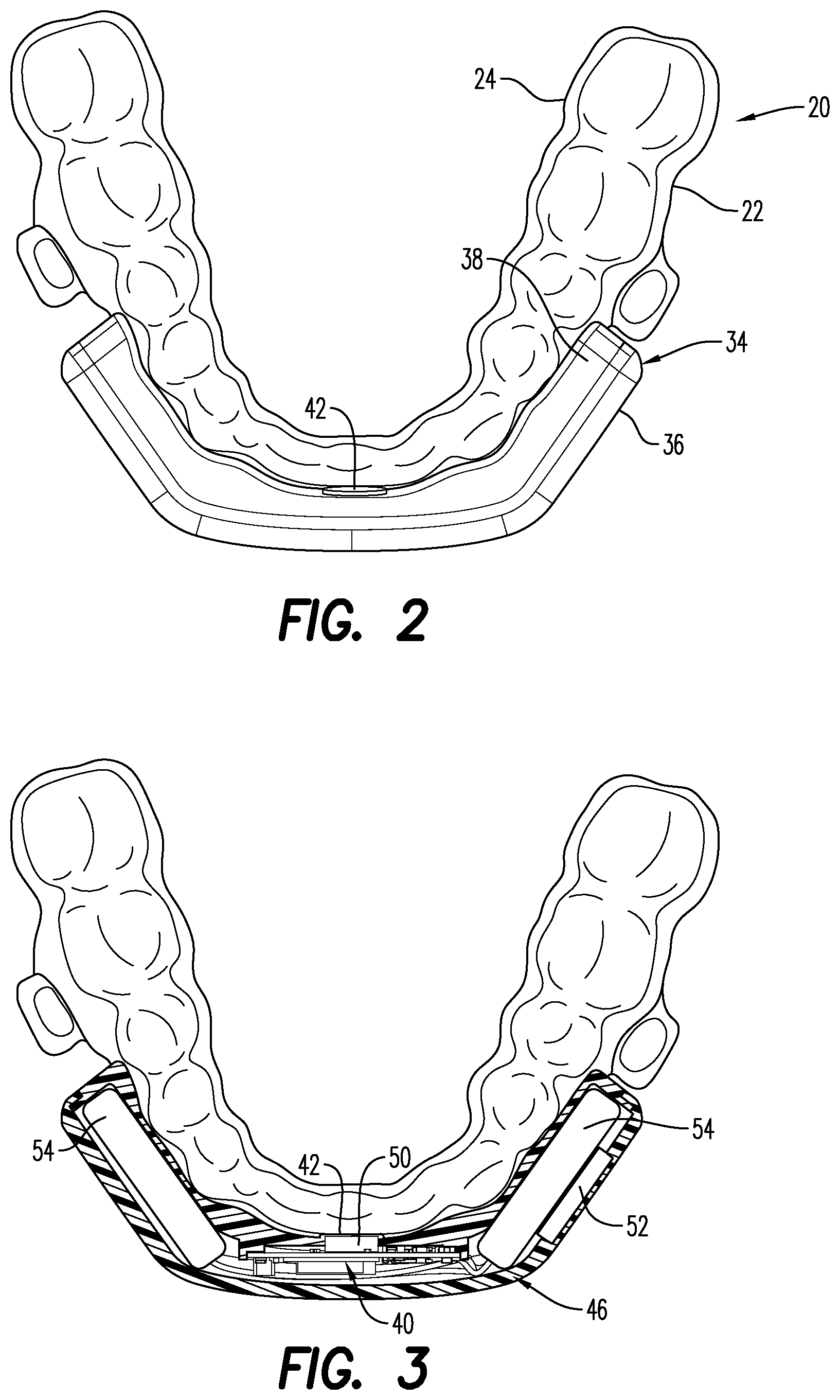 Patent US12403033 Figure 2 – Oral appliance for the treatment of sleep apnea