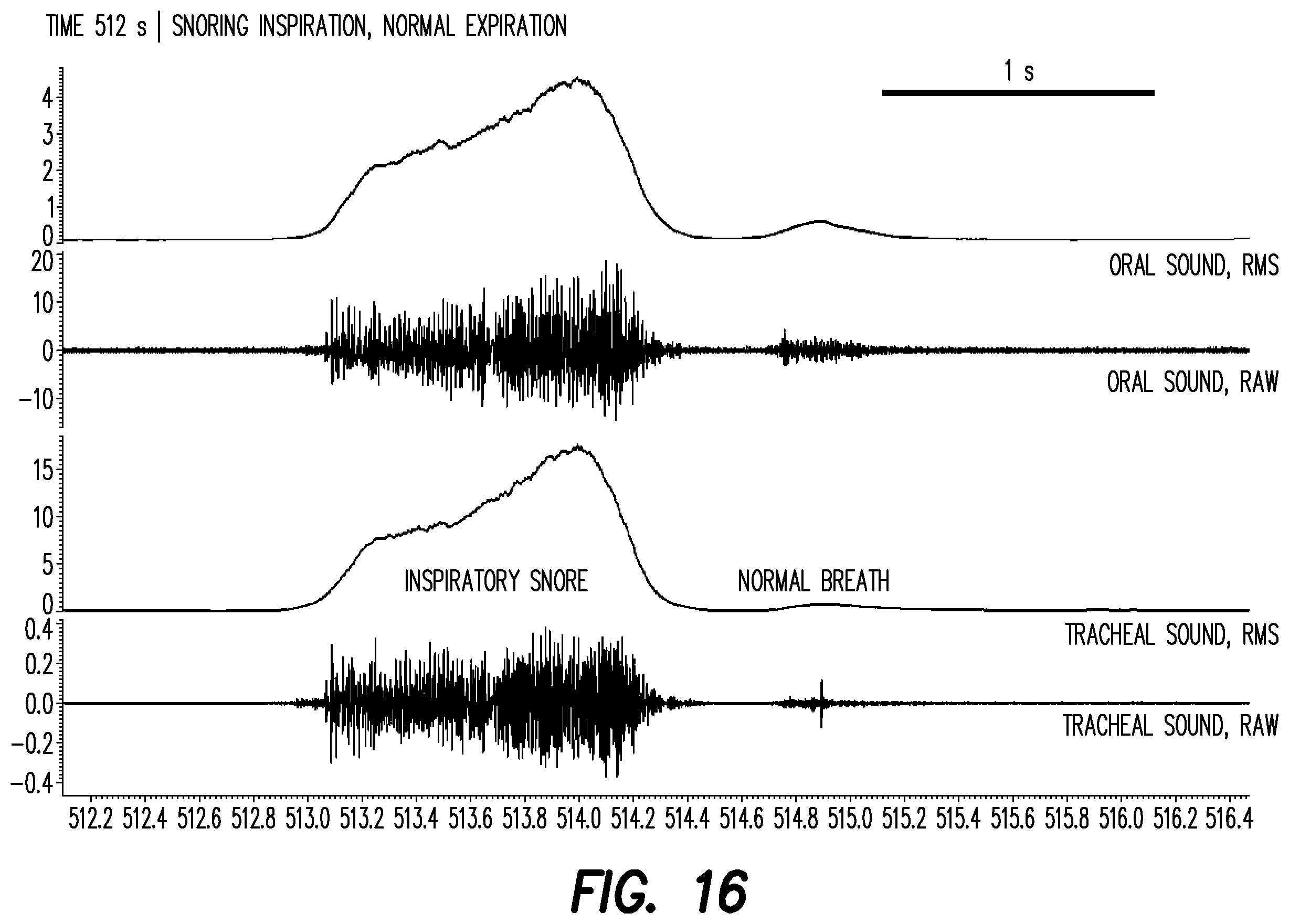 Patent US12403033 Figure 11 – Oral appliance for the treatment of sleep apnea