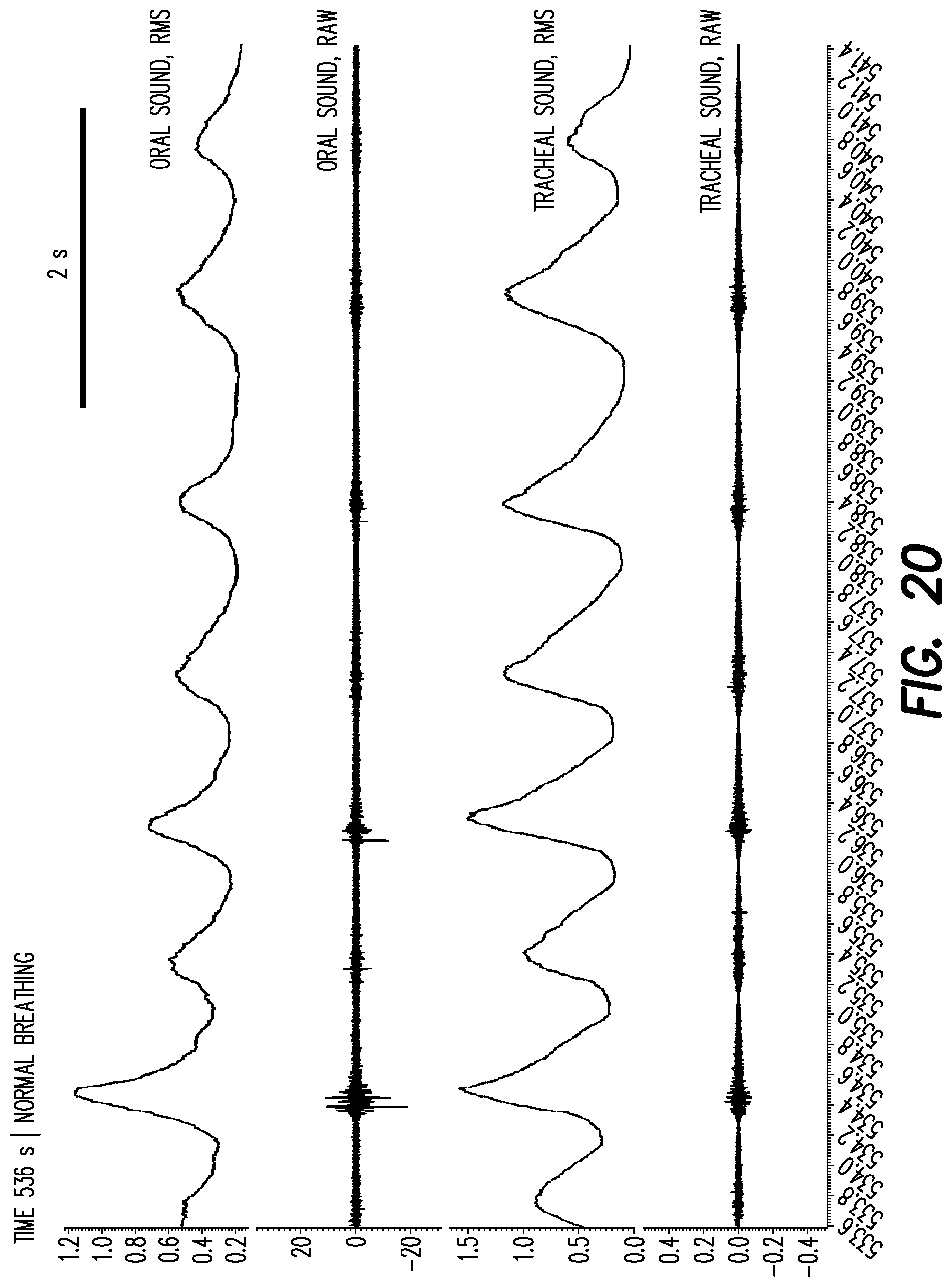 Patent US12403033 Figure 15 – Oral appliance for the treatment of sleep apnea