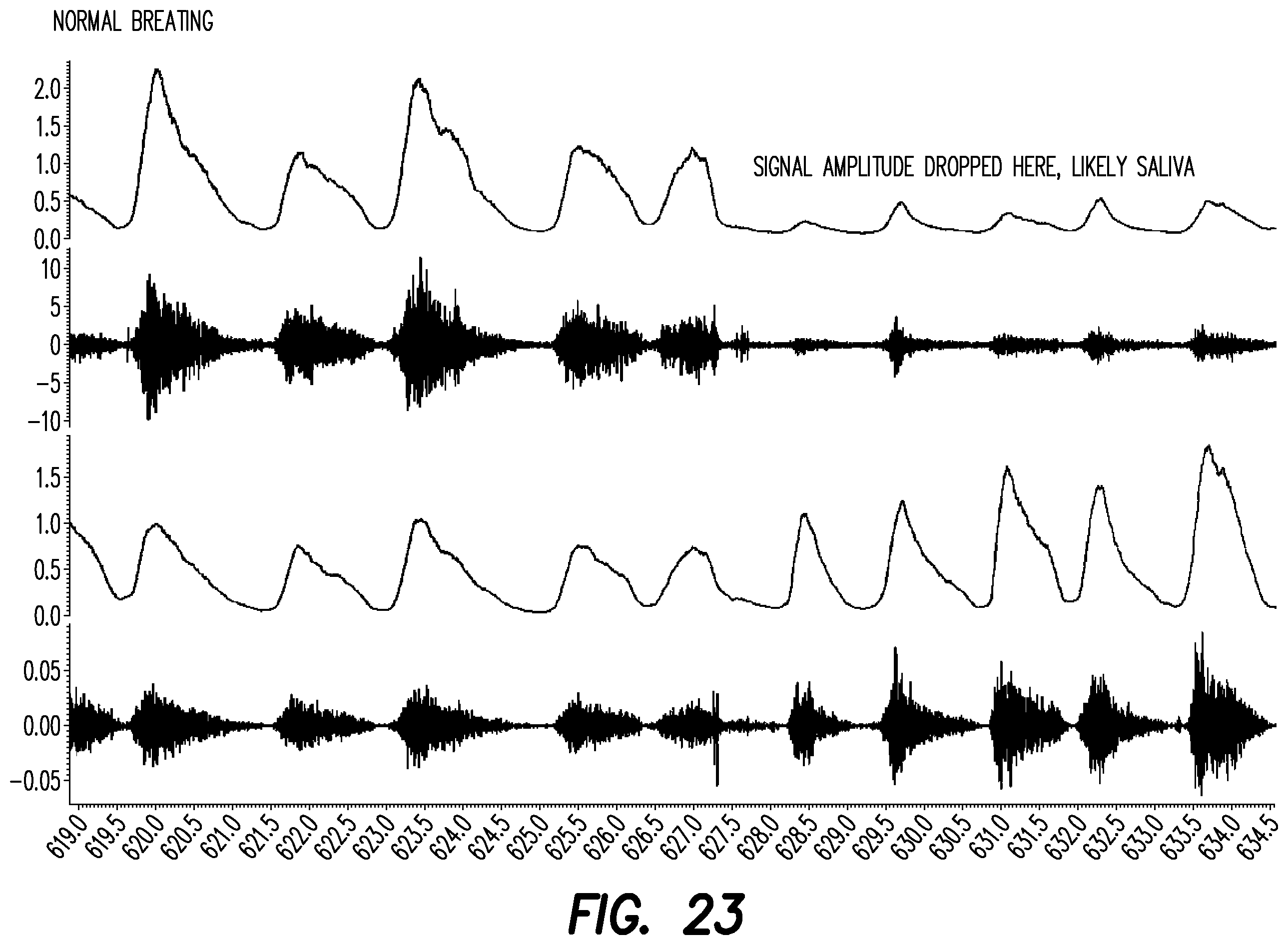 Patent US12403033 Figure 18 – Oral appliance for the treatment of sleep apnea