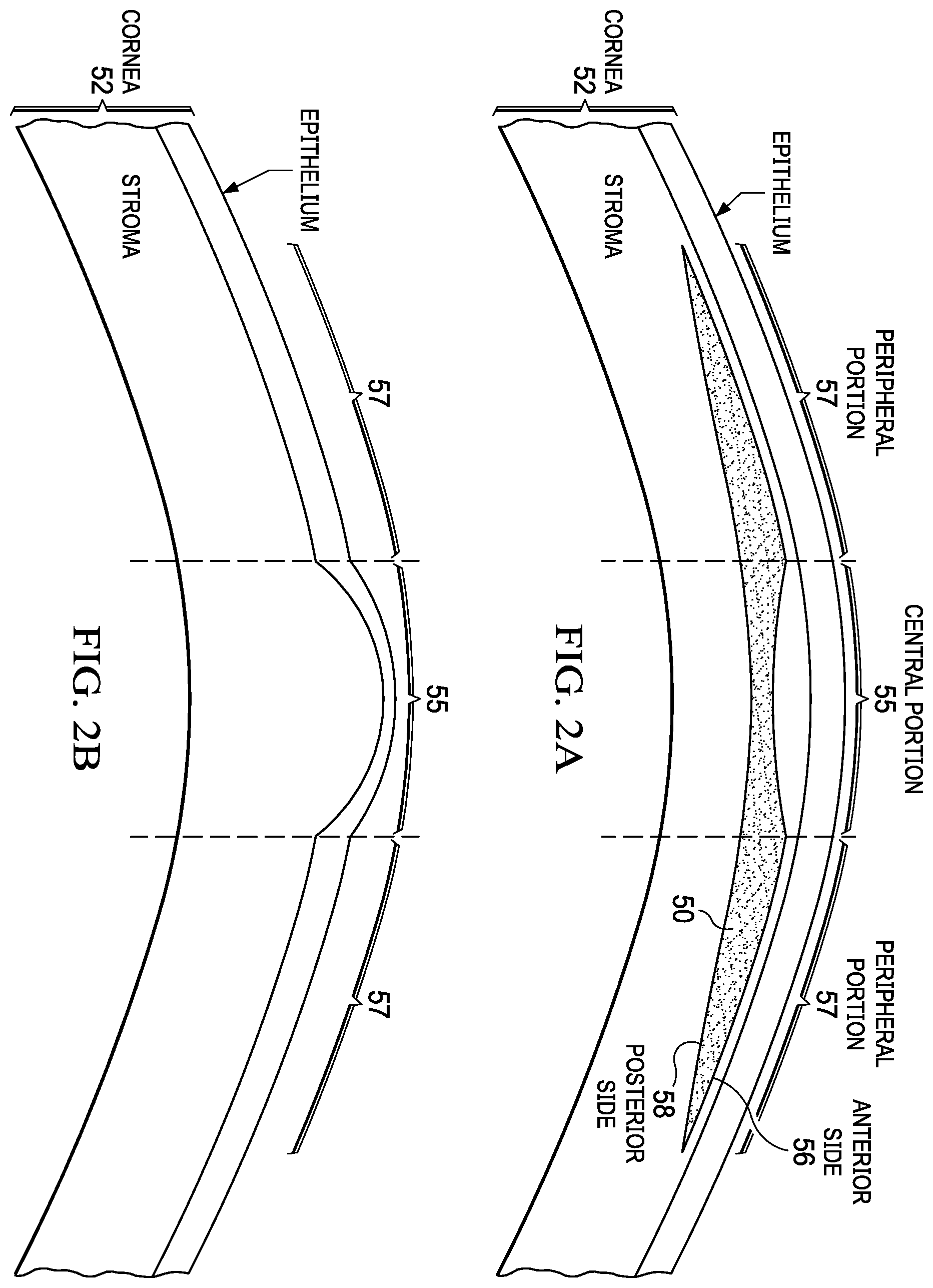 Patent US12403038 Figure 2 – Systems and methods for creating a lenticule for presbyopia