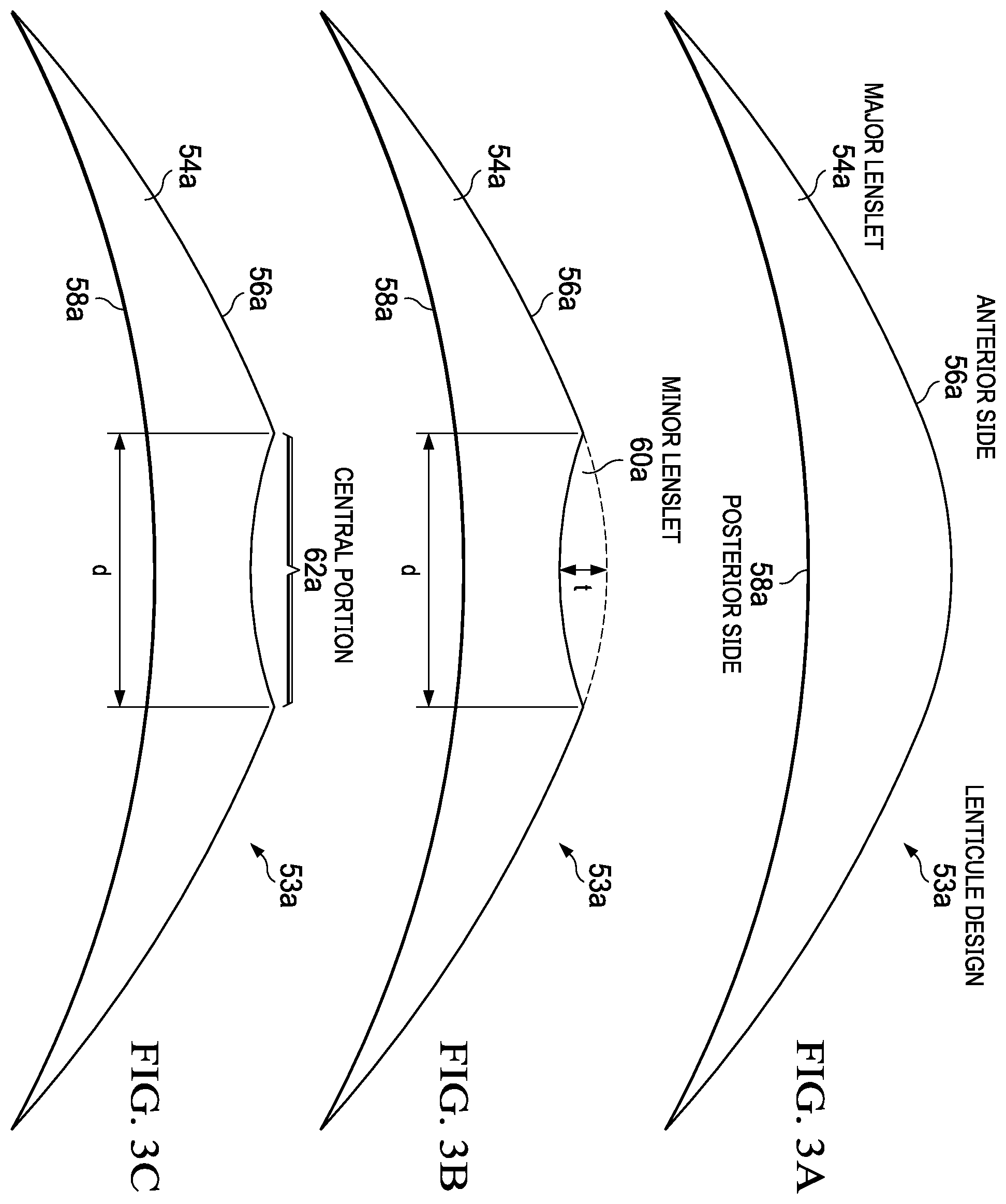 Patent US12403038 Figure 3 – Systems and methods for creating a lenticule for presbyopia