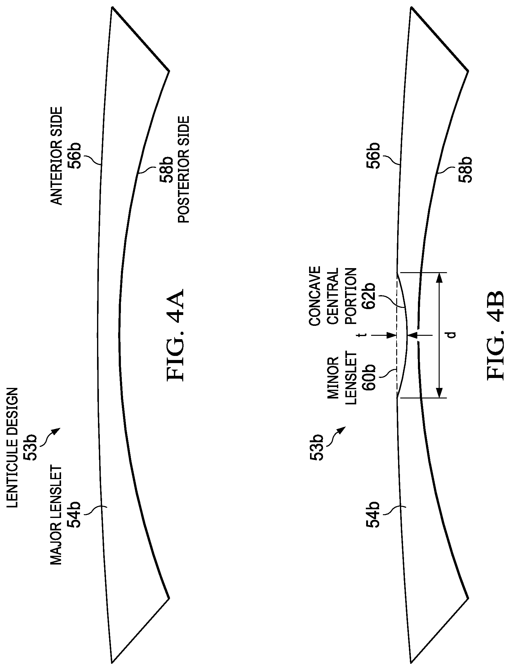 Patent US12403038 Figure 4 – Systems and methods for creating a lenticule for presbyopia