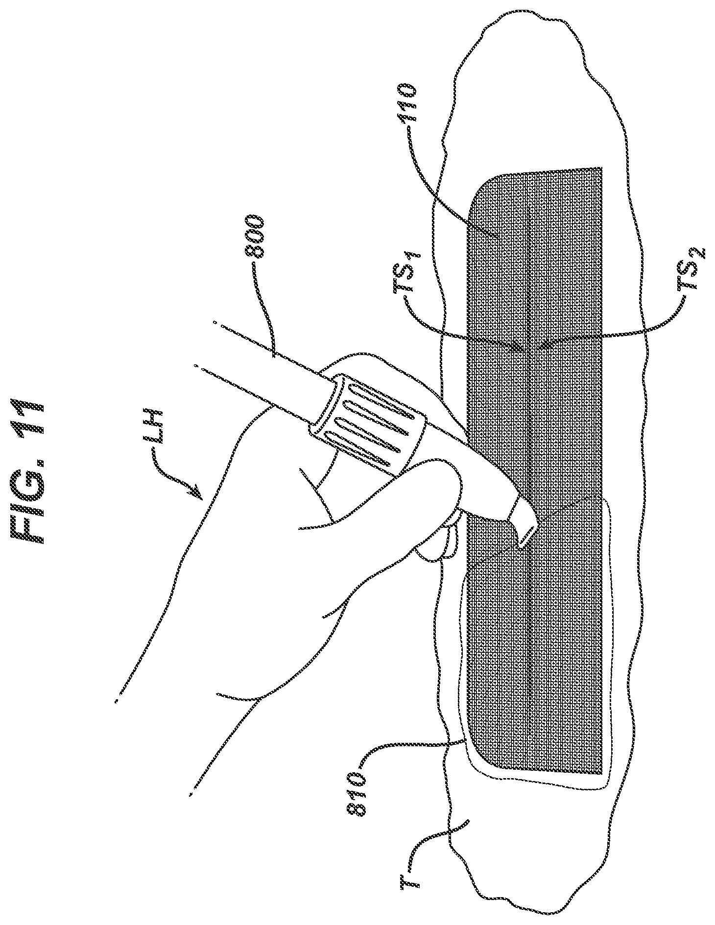 Patent US12403043 Figure 7 – Methods and devices for skin closure