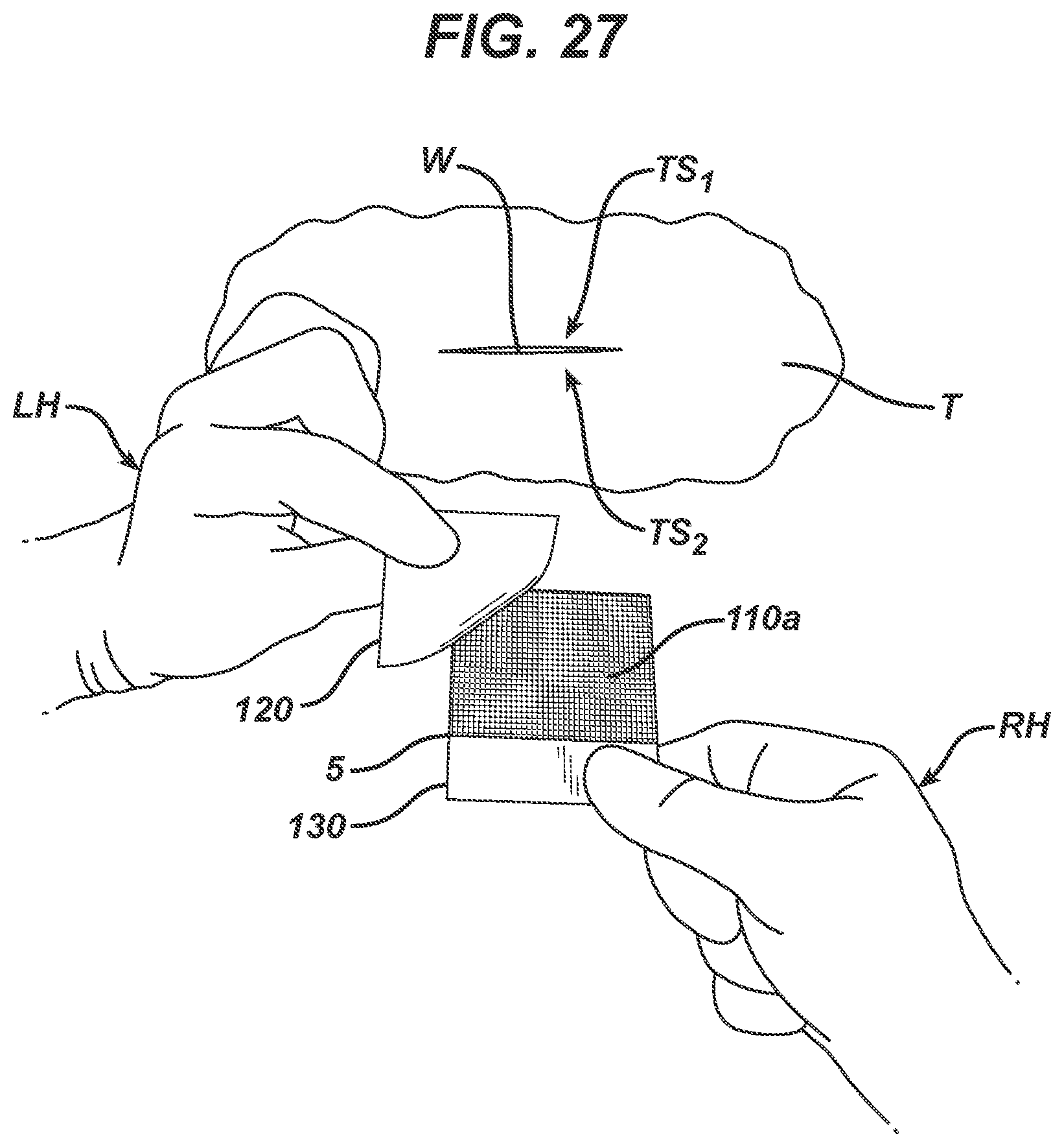 Patent US12403043 Figure 15 – Methods and devices for skin closure