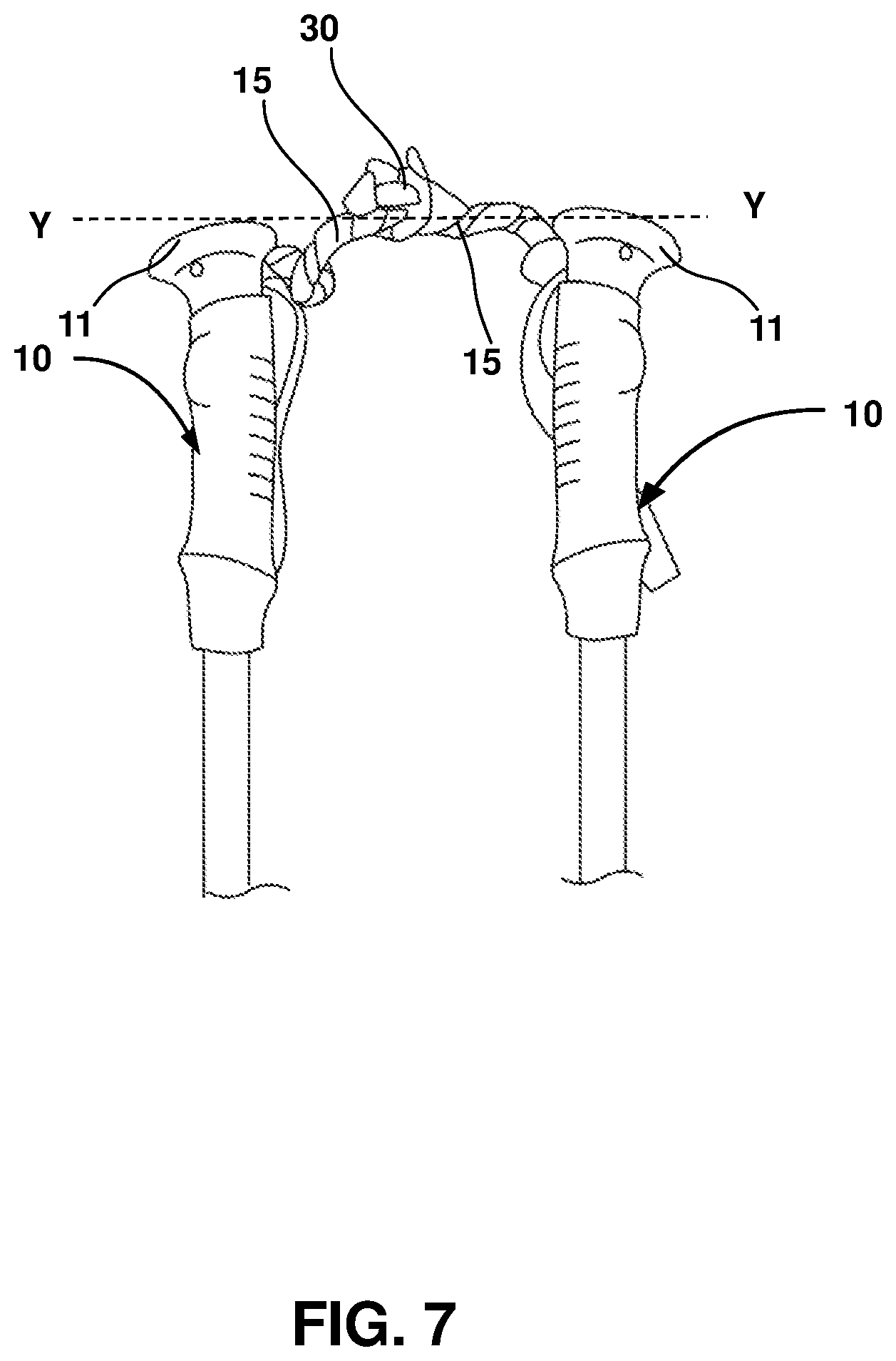 Patent US12403062 Figure 7 – Crutch assembly constructed using a pair of hiking poles