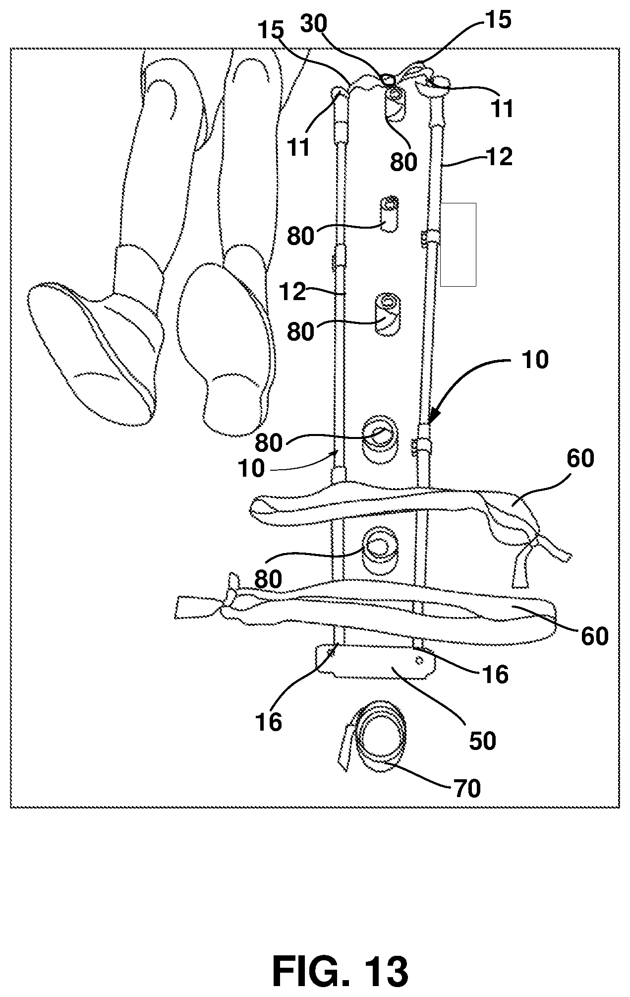 Patent US12403062 Figure 13 – Crutch assembly constructed using a pair of hiking poles