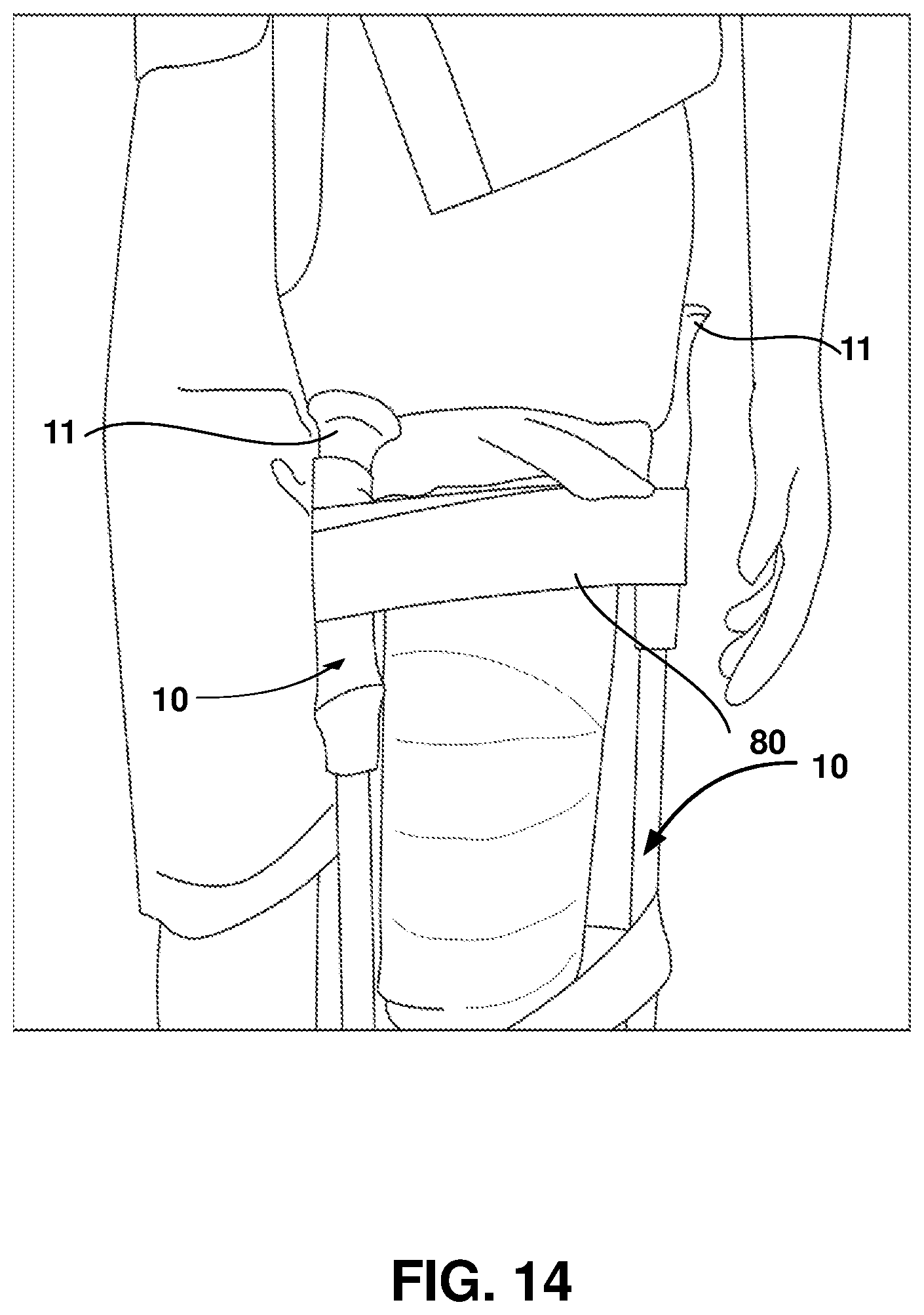 Patent US12403062 Figure 14 – Crutch assembly constructed using a pair of hiking poles