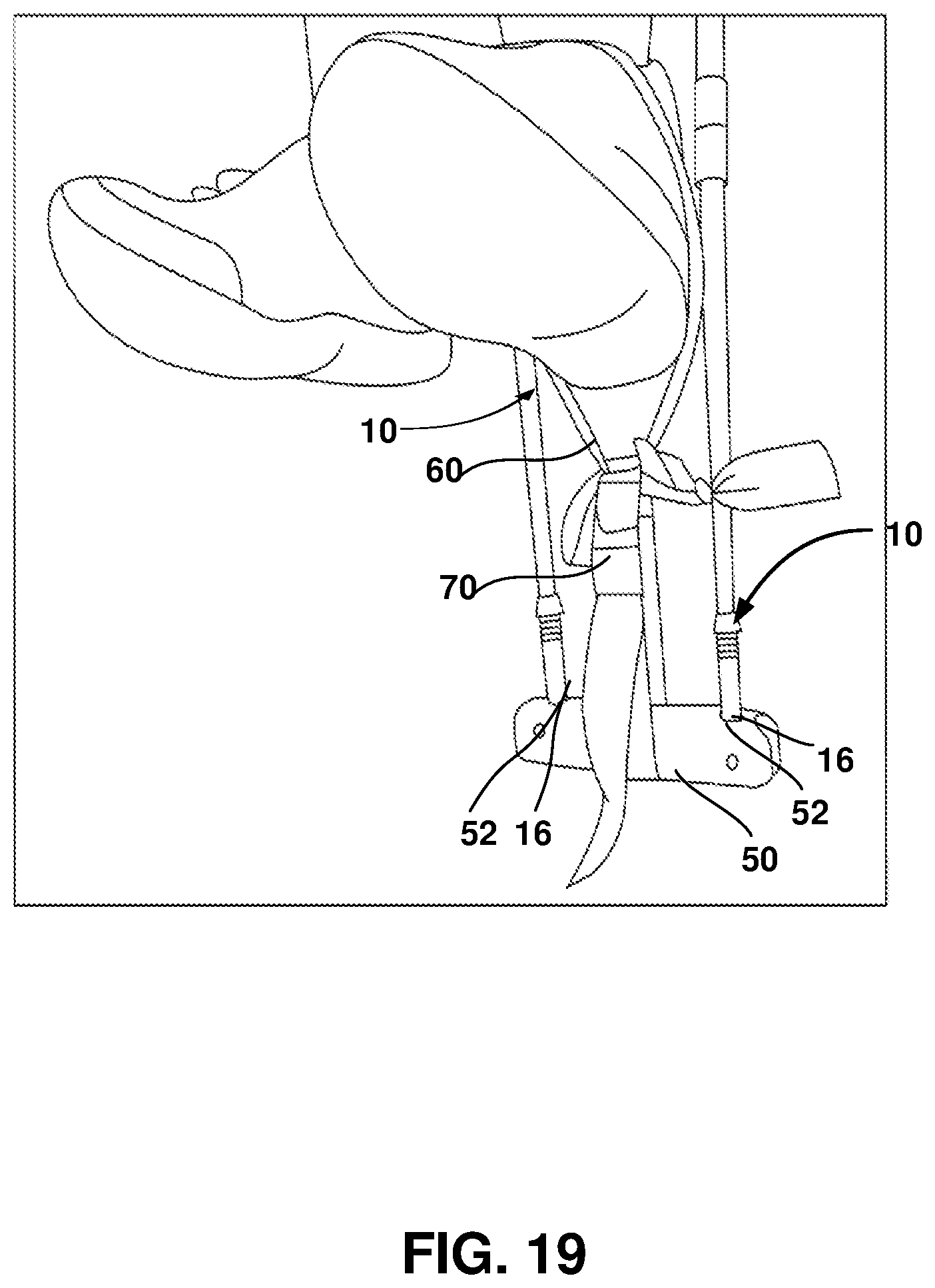 Patent US12403062 Figure 19 – Crutch assembly constructed using a pair of hiking poles