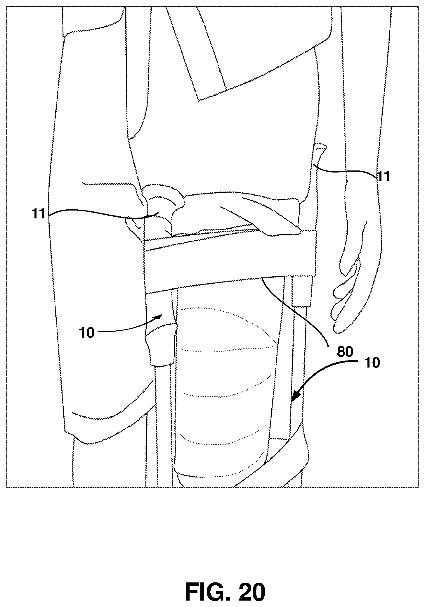 Patent US12403062 Figure 20 – Crutch assembly constructed using a pair of hiking poles