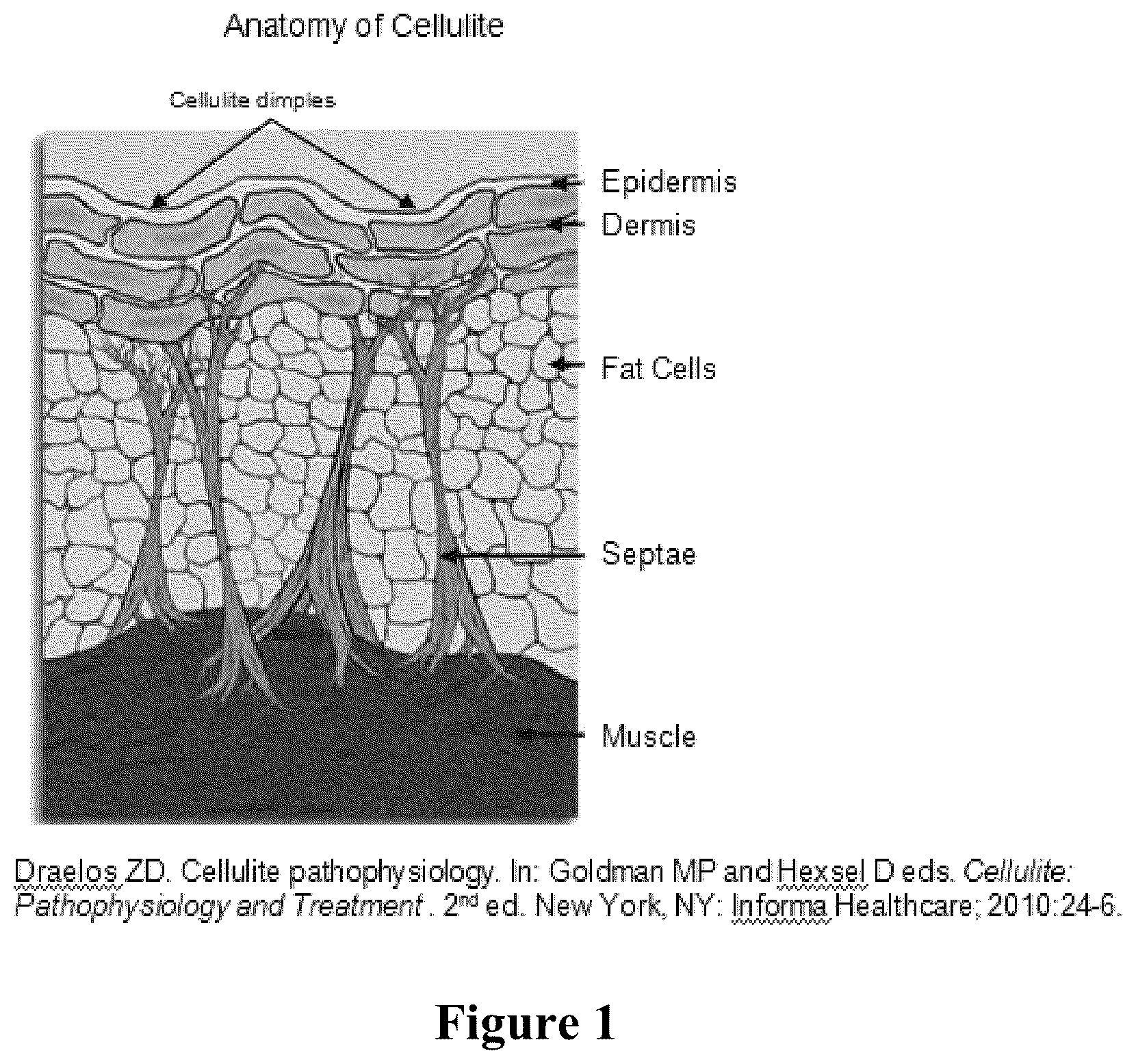 Patent US12403081 — Method of assessing and treating cellulite — Figure 1