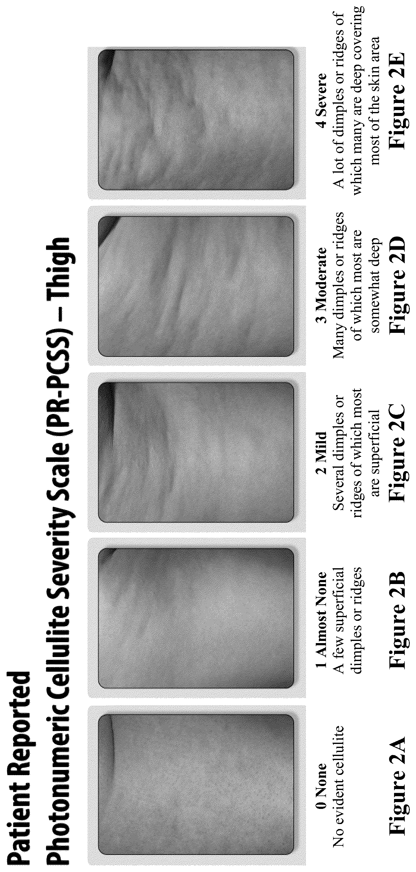 Patent US12403081 Figure 2 – Method of assessing and treating cellulite