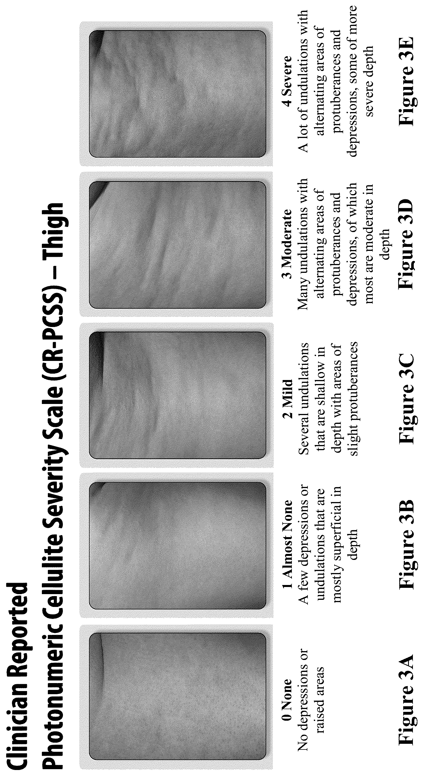 Patent US12403081 Figure 3 – Method of assessing and treating cellulite