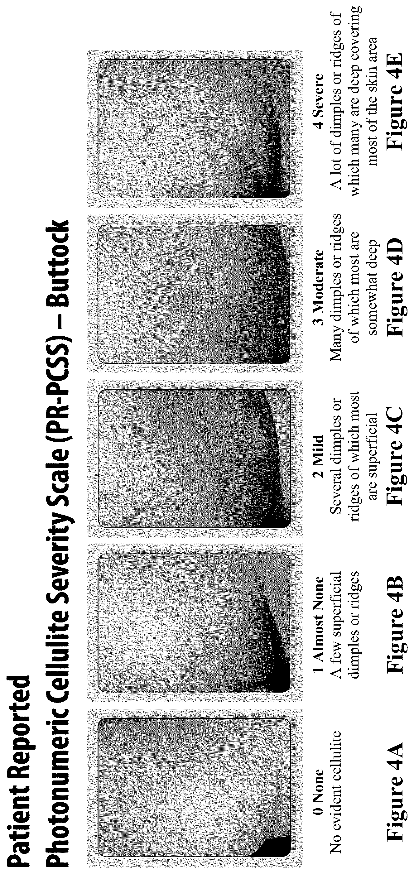 Patent US12403081 Figure 4 – Method of assessing and treating cellulite