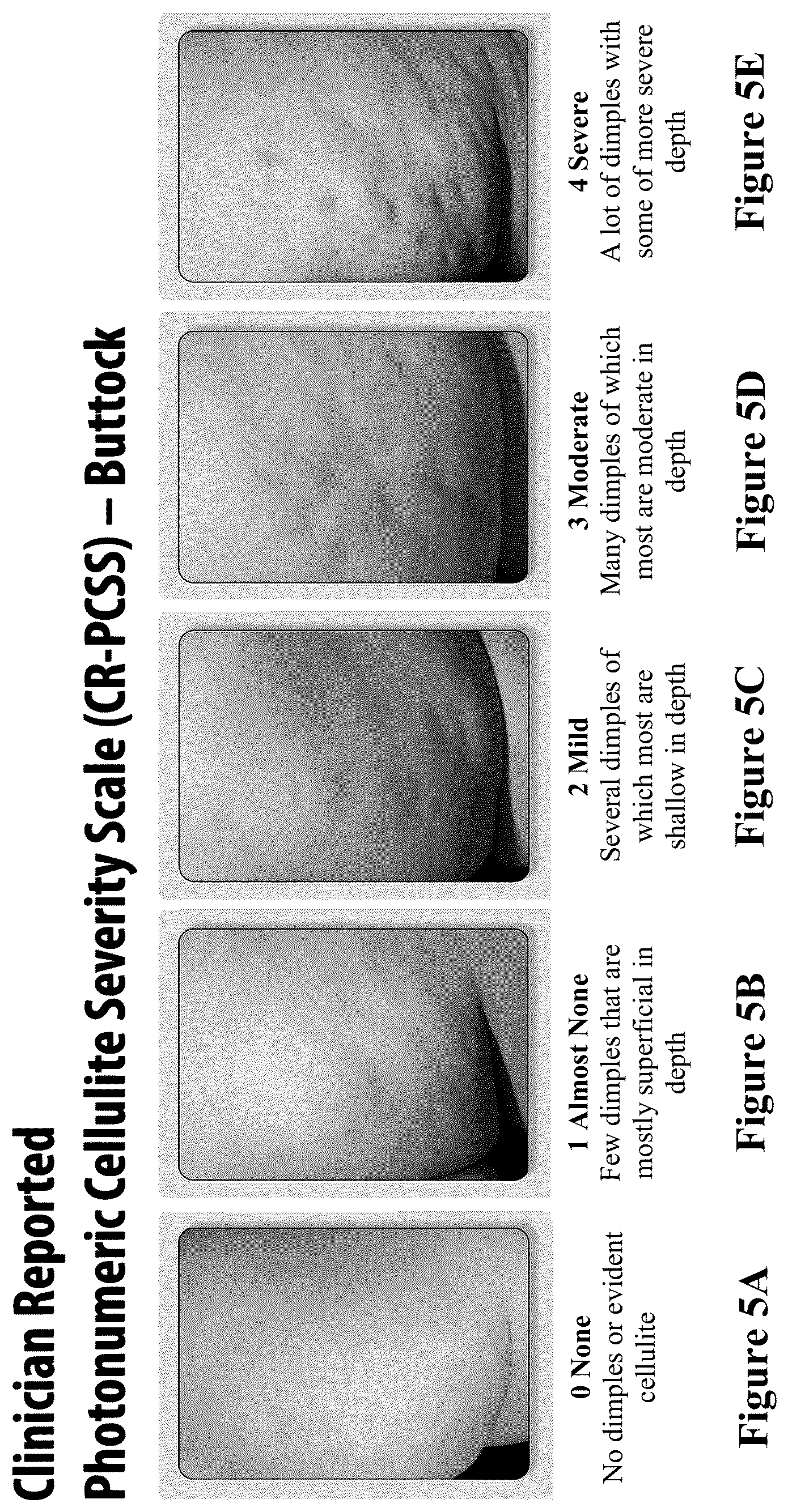 Patent US12403081 Figure 5 – Method of assessing and treating cellulite