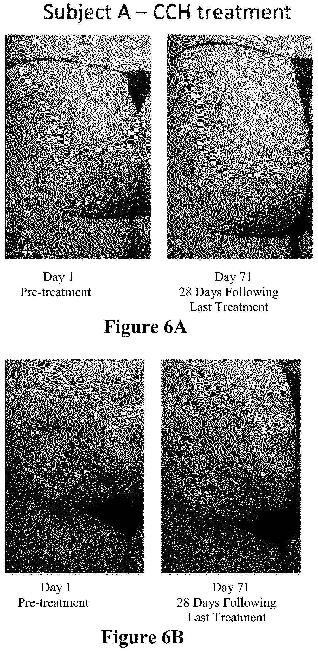 Patent US12403081 Figure 6 – Method of assessing and treating cellulite