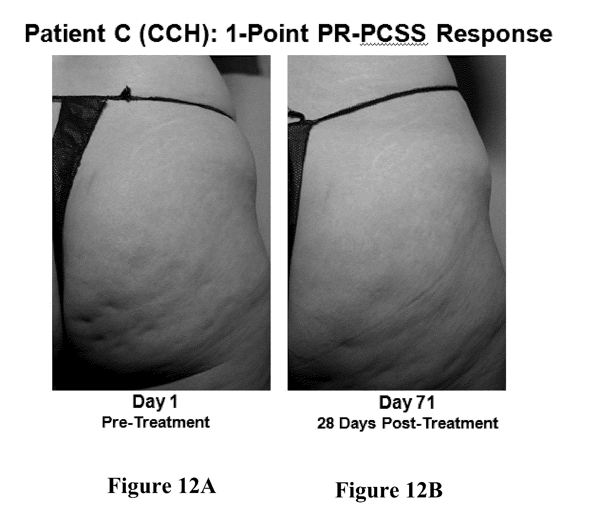 Patent US12403081 Figure 11 – Method of assessing and treating cellulite