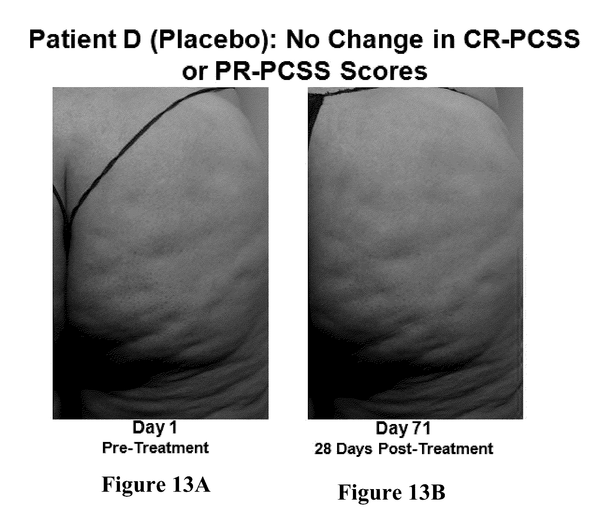 Patent US12403081 Figure 12 – Method of assessing and treating cellulite