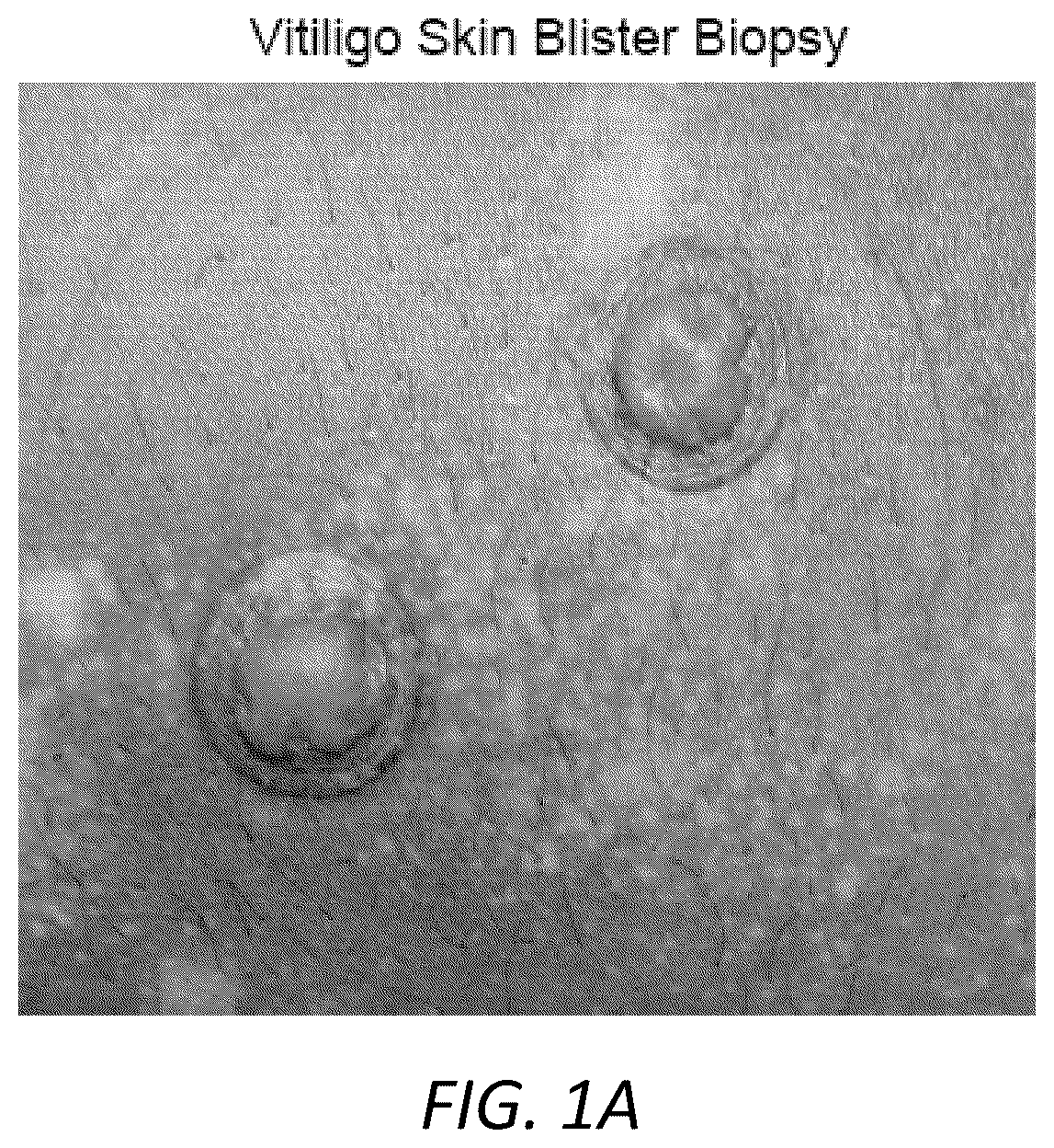 Patent US12403105 Figure 1 – Diagnosis and treatment of vitiligo