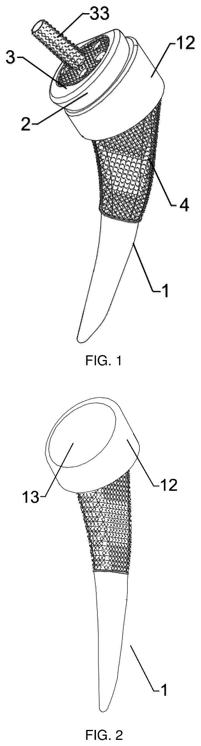 Patent US12403215 Figure 1 – Oxide layer-containing zirconium-niobium alloy shoulder joint prosthesis system and preparation method