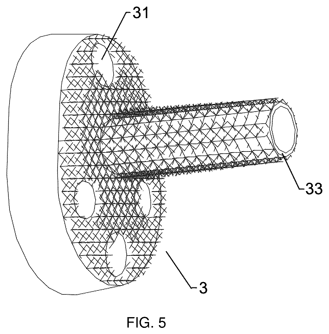 Patent US12403215 Figure 3 – Oxide layer-containing zirconium-niobium alloy shoulder joint prosthesis system and preparation method