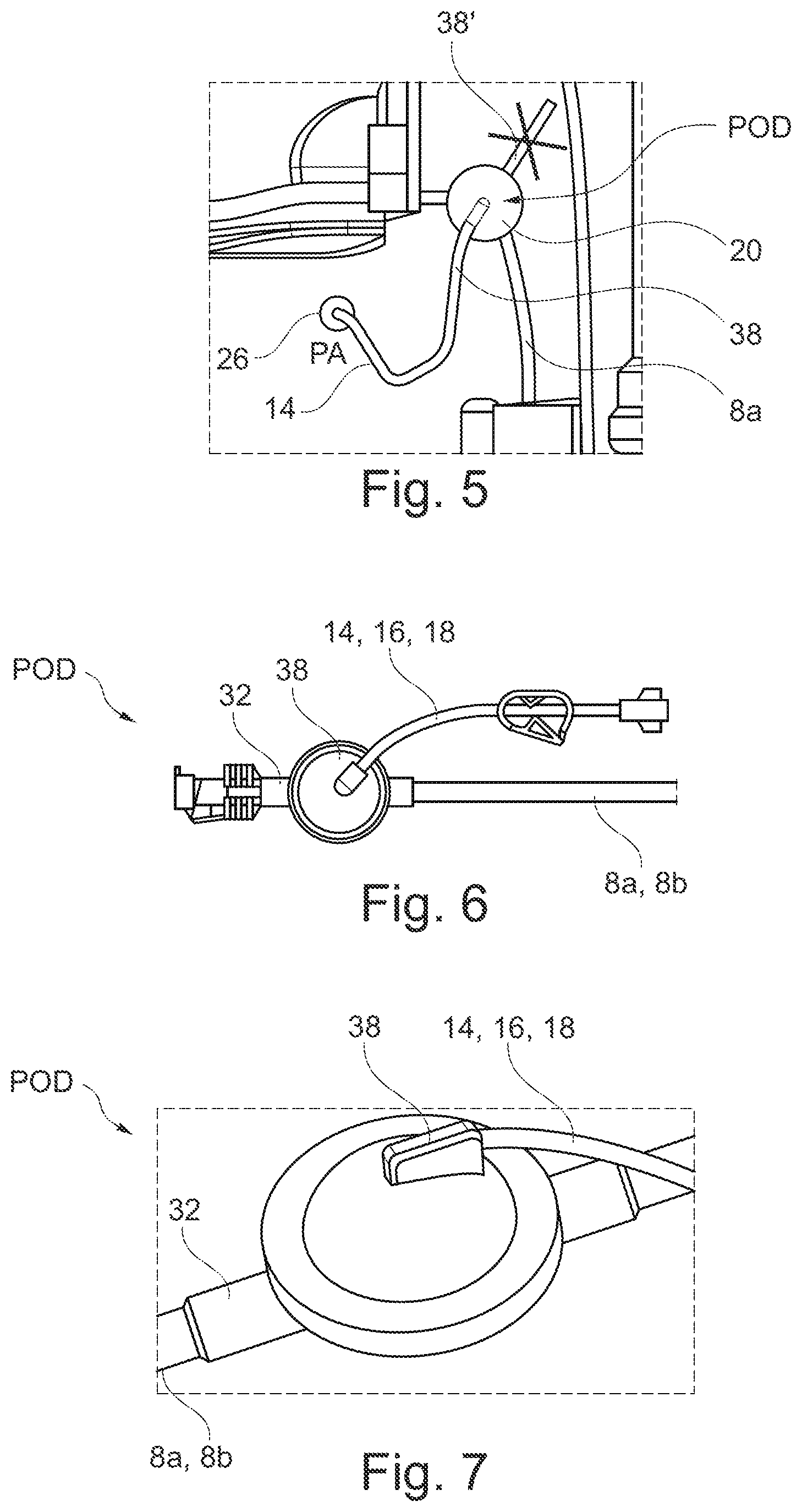 Patent US12403232 Figure 4 – Extracorporeal blood treatment machine comprising a poka-yoke for a pressure sensor