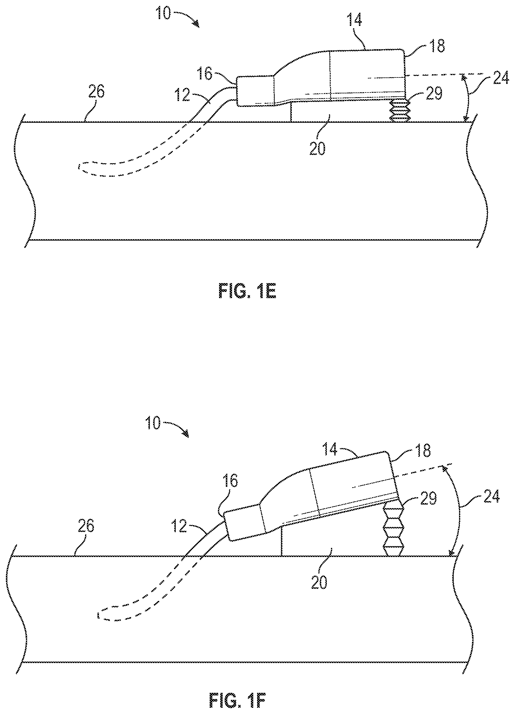 Patent US12403284 Figure 3 – Catheter assembly with angle changing and related methods