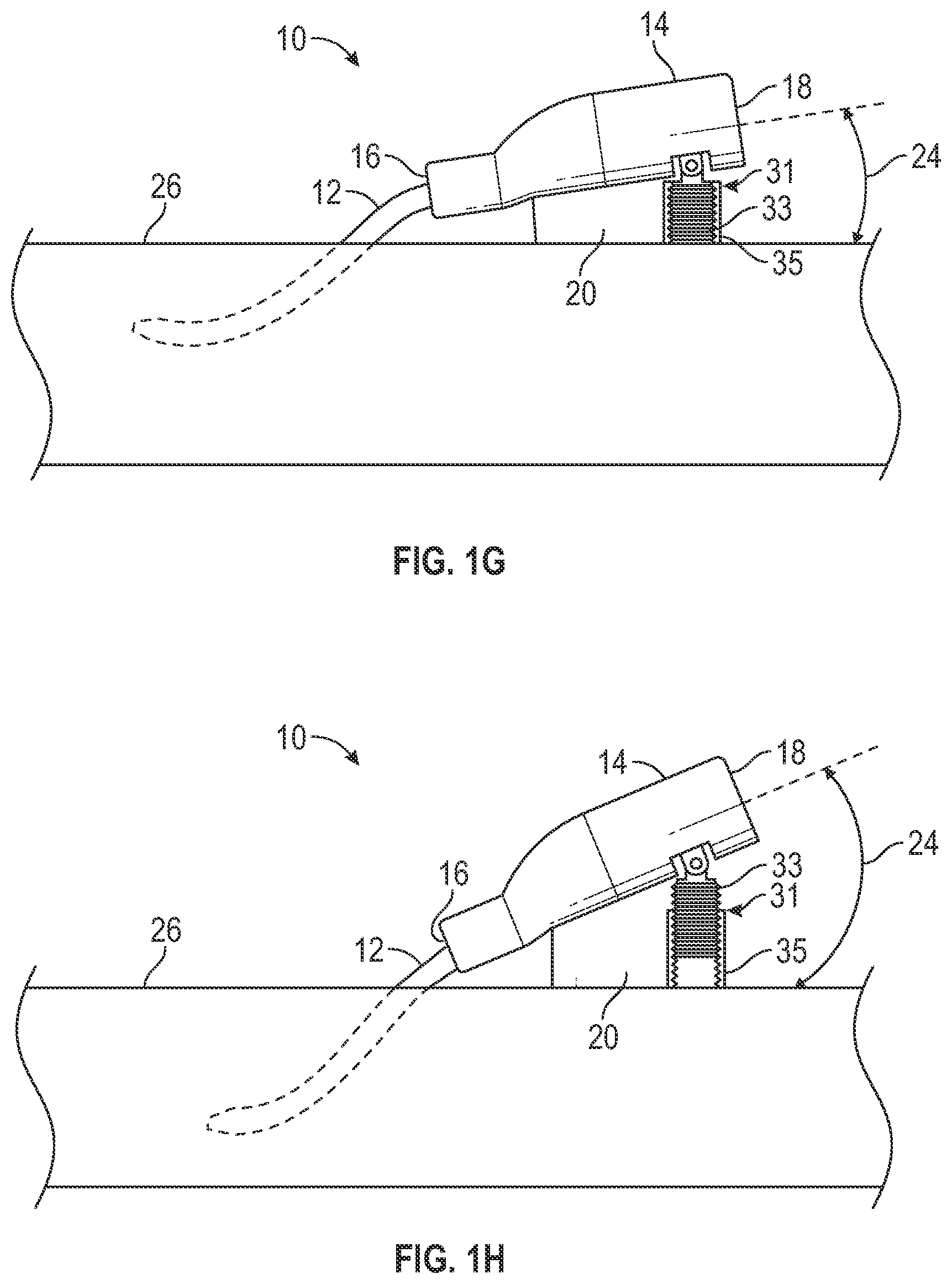 Patent US12403284 Figure 4 – Catheter assembly with angle changing and related methods