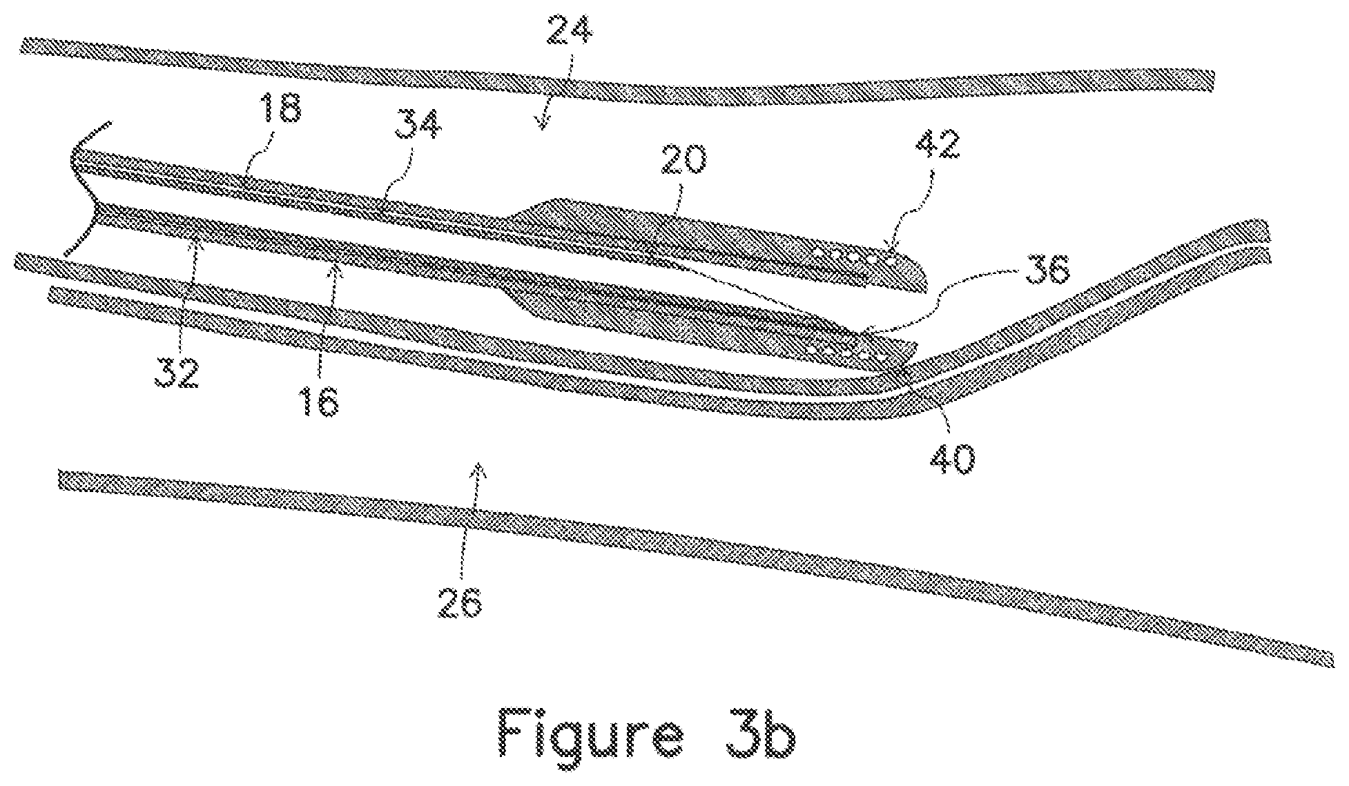 Patent US12403289 Figure 6 – Systems and methods for percutaneous intravascular access and guidewire placement