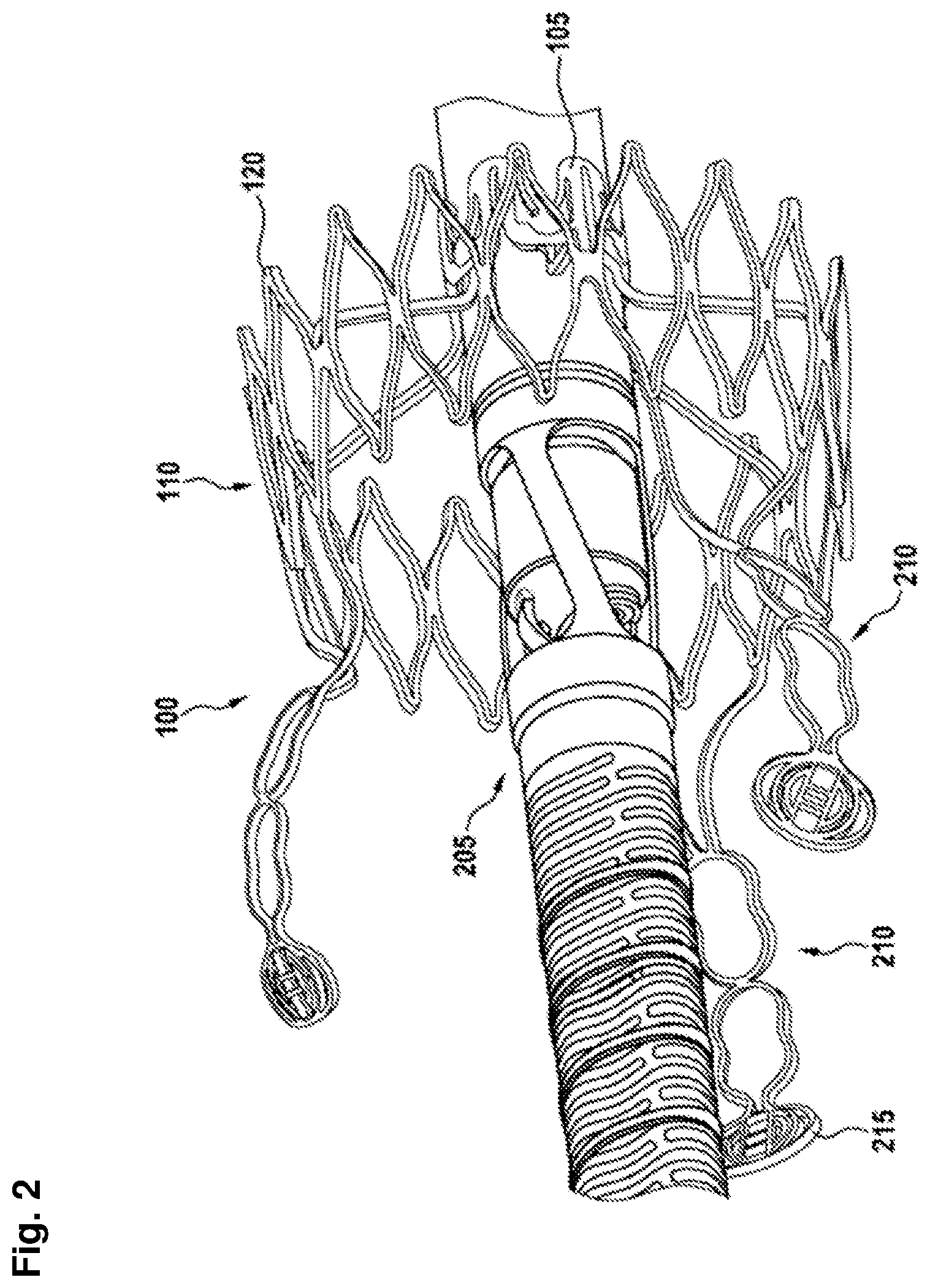 Patent US12403296 Figure 2 – Apparatus for anchoring a ventricular assist system in a blood vessel, operating method, production method for producing an apparatus and ventricular assist system
