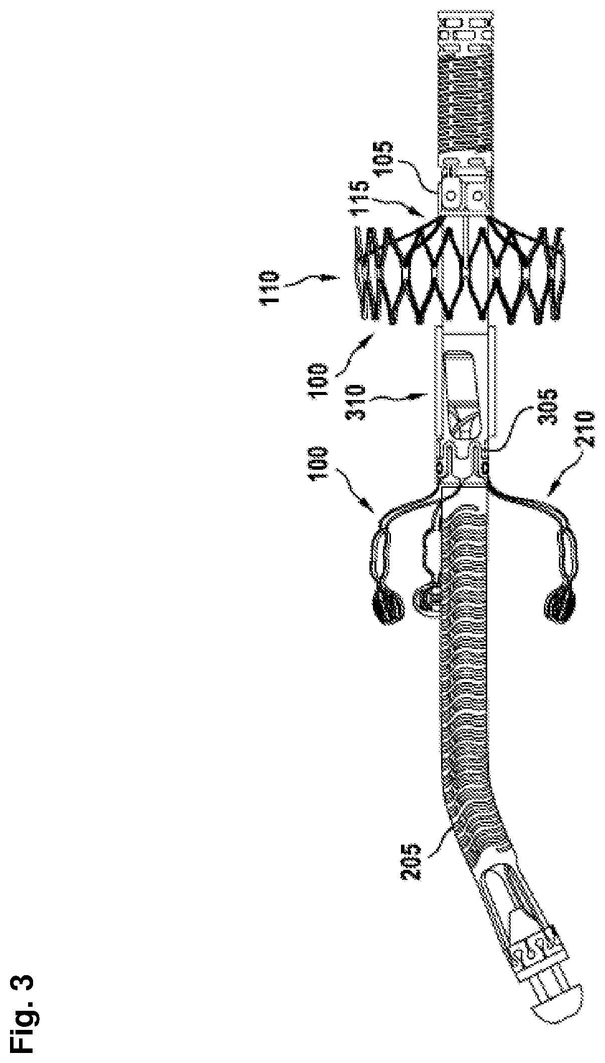 Patent US12403296 Figure 3 – Apparatus for anchoring a ventricular assist system in a blood vessel, operating method, production method for producing an apparatus and ventricular assist system