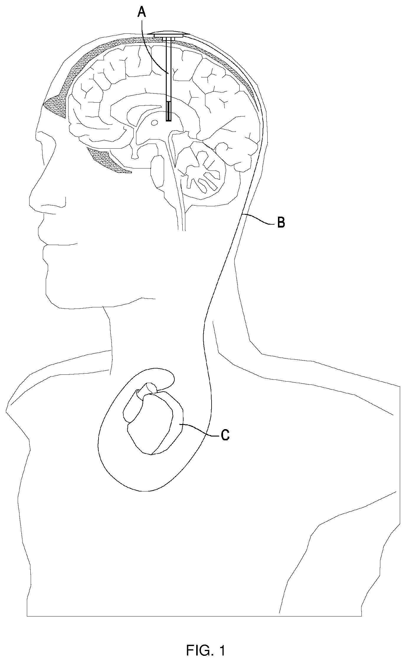 Patent US12403301 Figure 1 – Lead for applying electrical stimulation to body organ, and electrode system using same