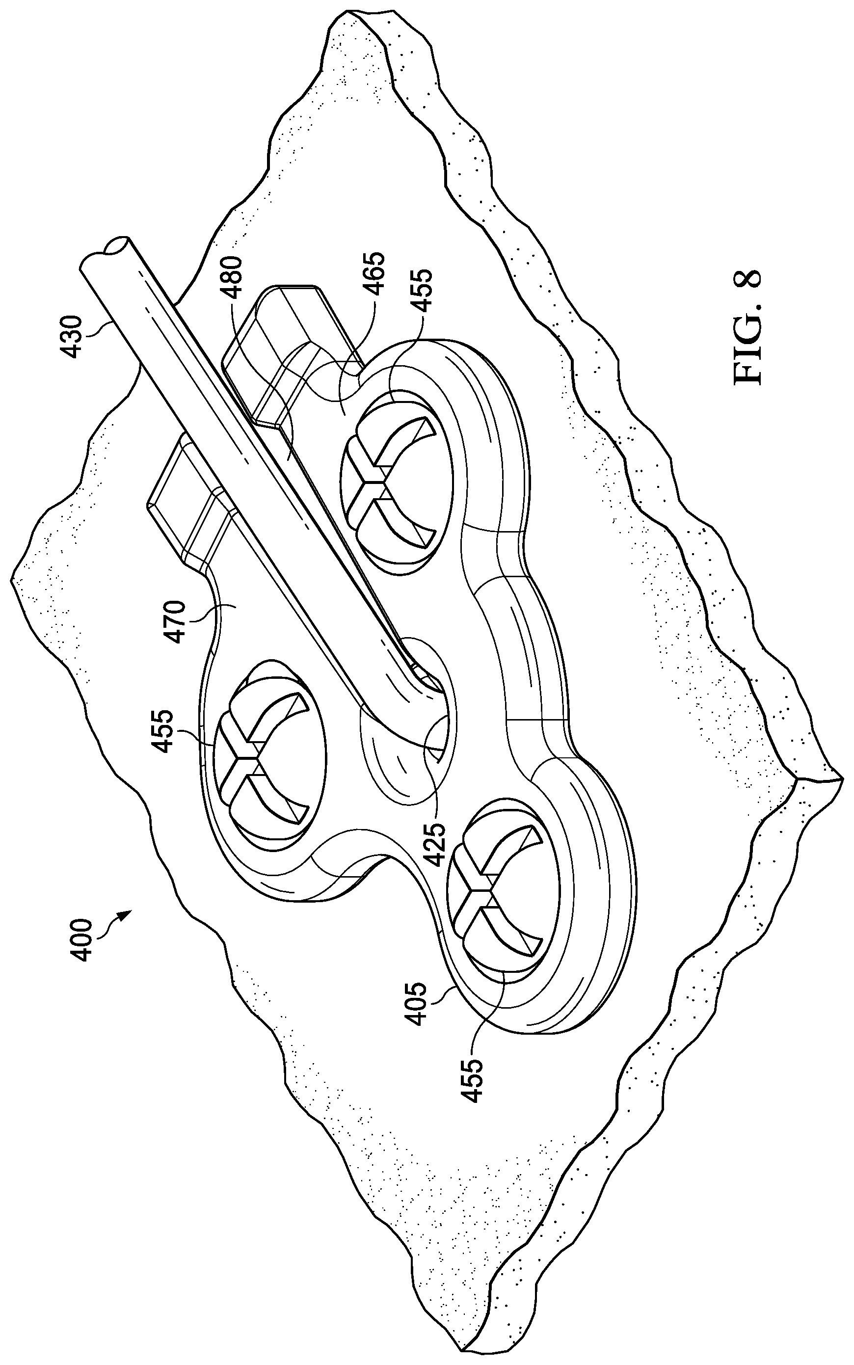 Patent US12403302 Figure 8 – Methods and apparatus for a lead fixation device
