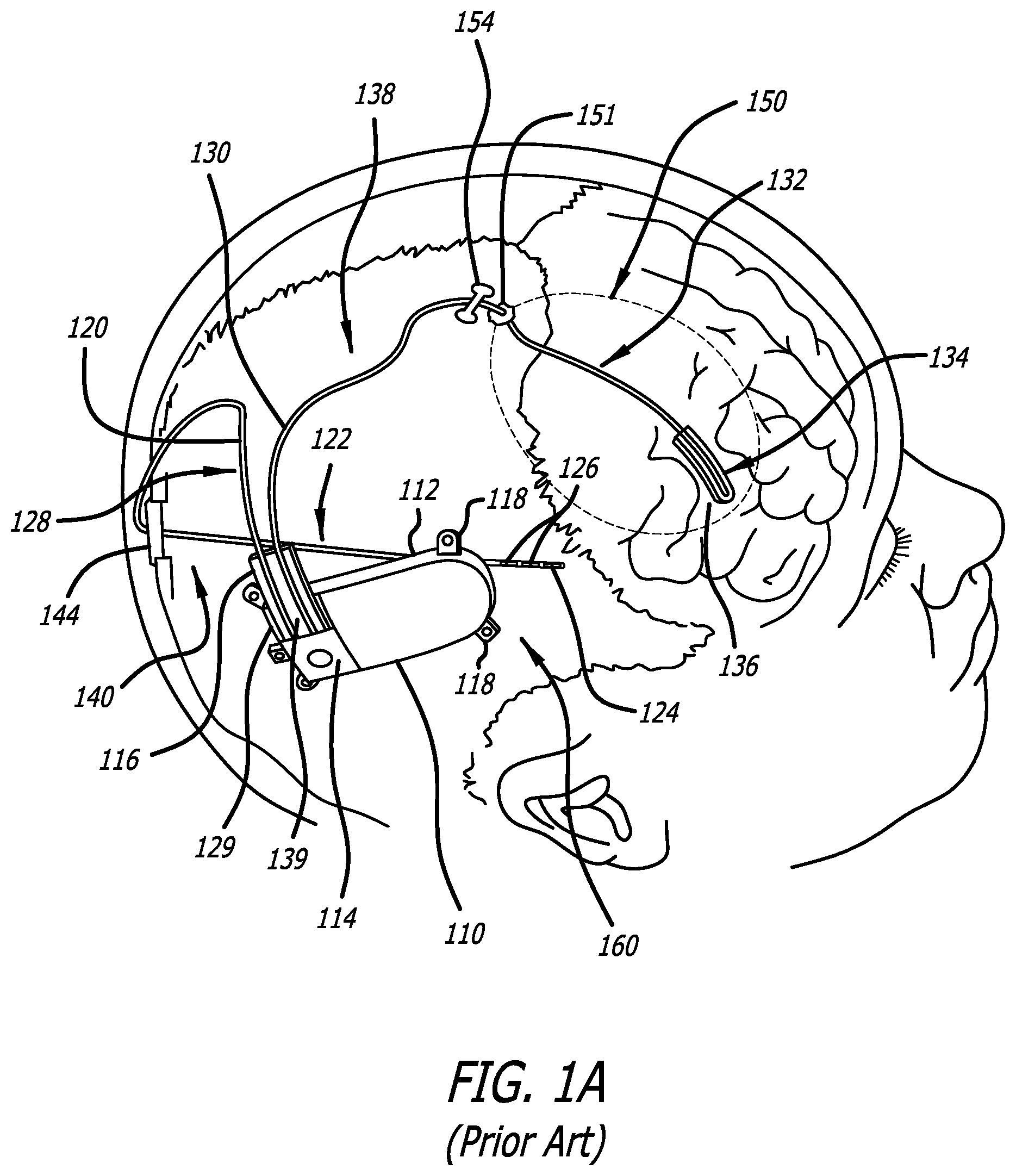 Patent US12403303 Figure 1 – Lead fixation devices for securing a lead to a cranium