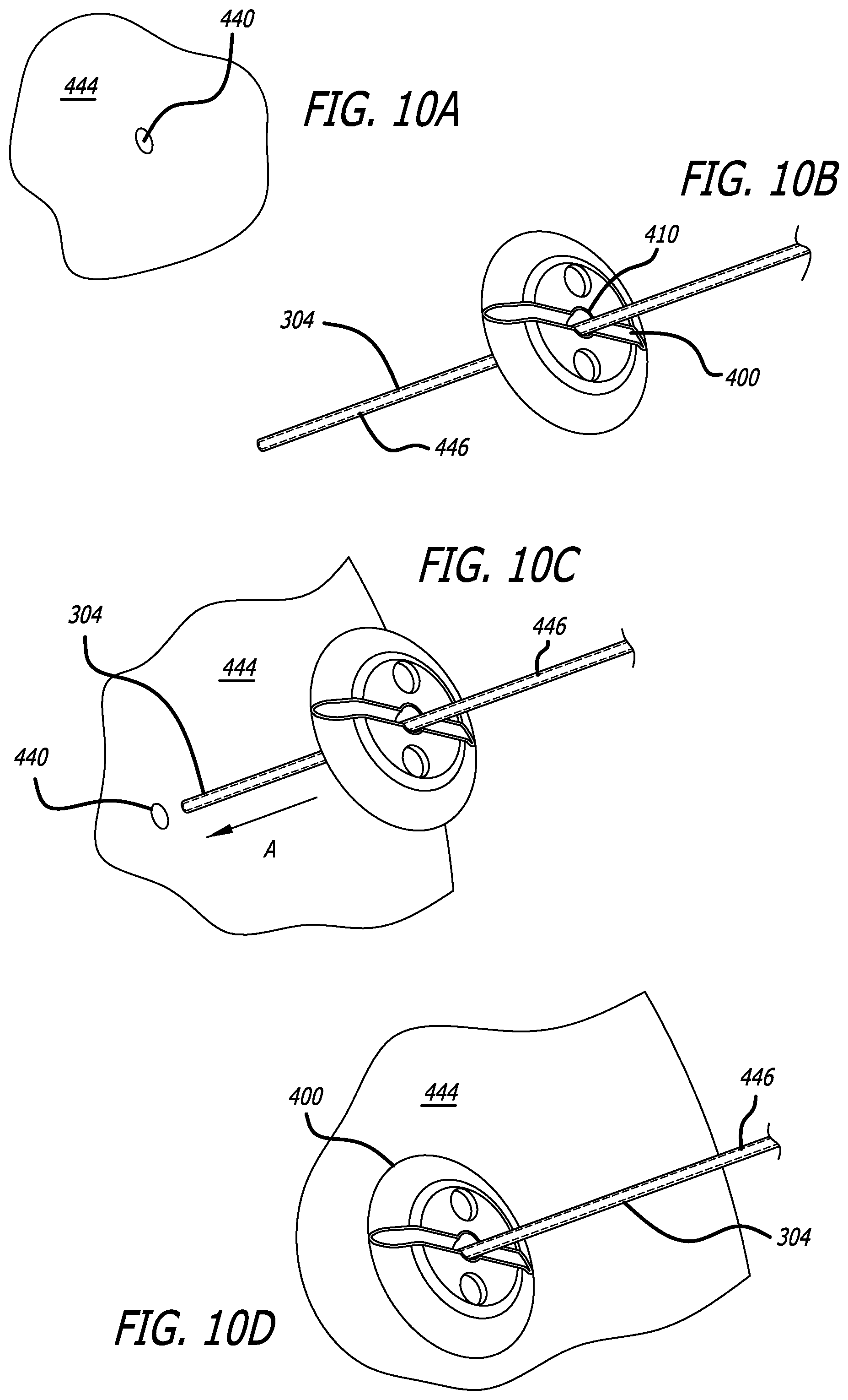 Patent US12403303 Figure 7 – Lead fixation devices for securing a lead to a cranium