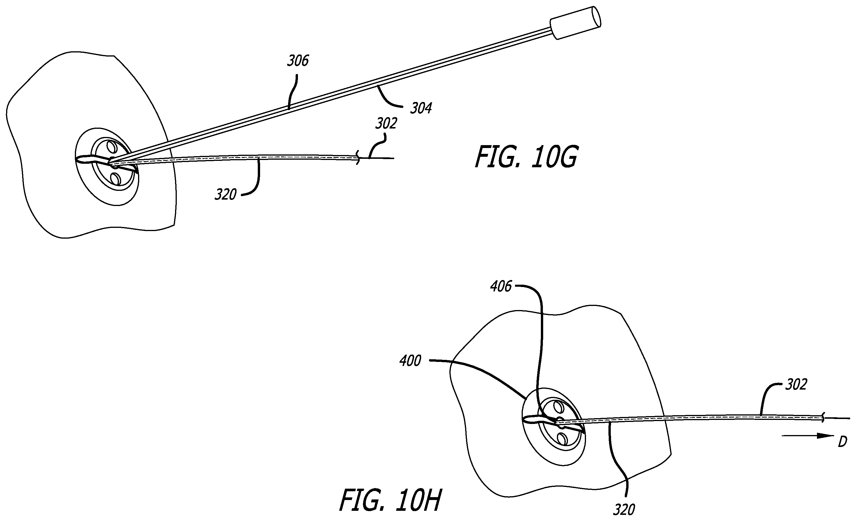 Patent US12403303 Figure 9 – Lead fixation devices for securing a lead to a cranium