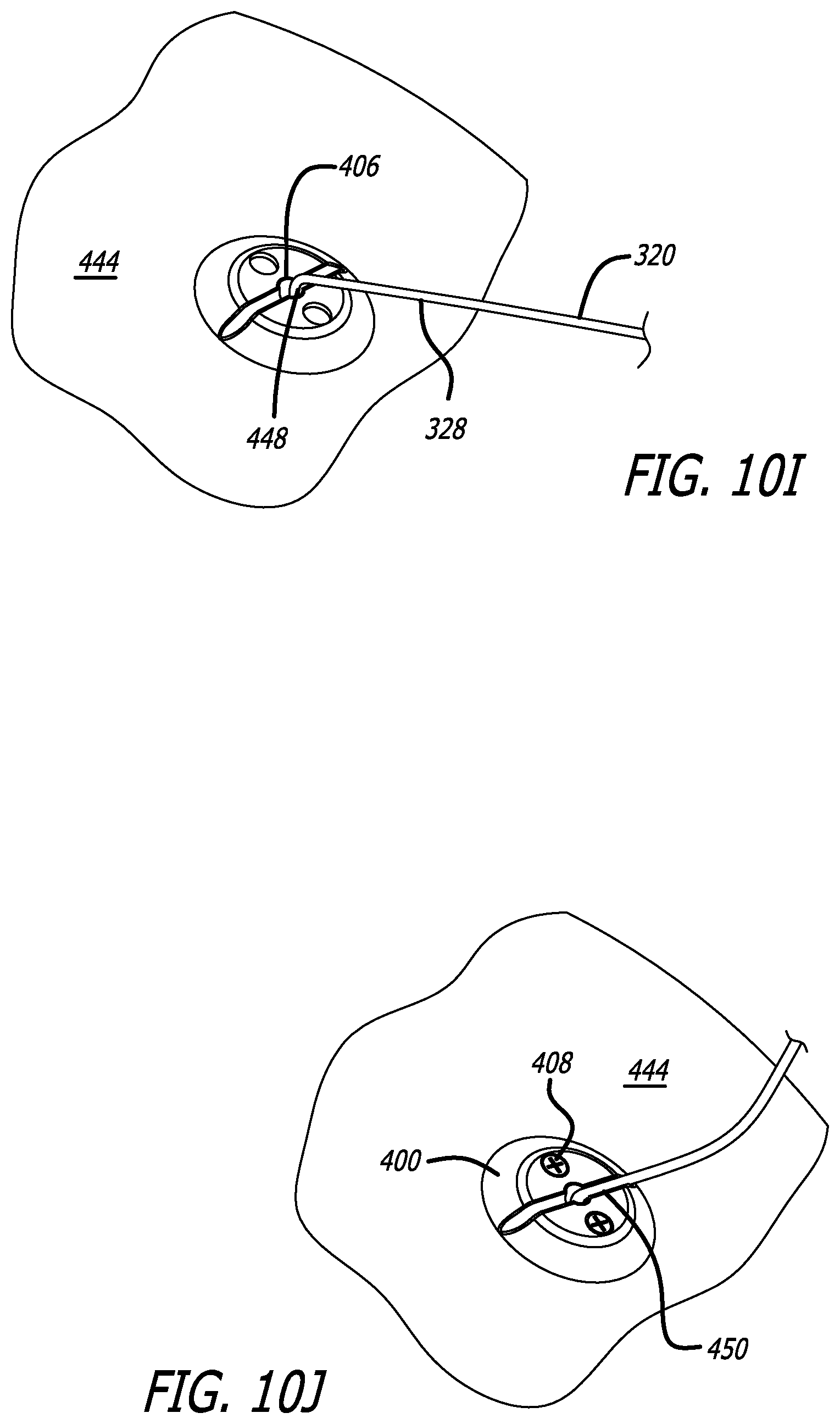 Patent US12403303 Figure 10 – Lead fixation devices for securing a lead to a cranium