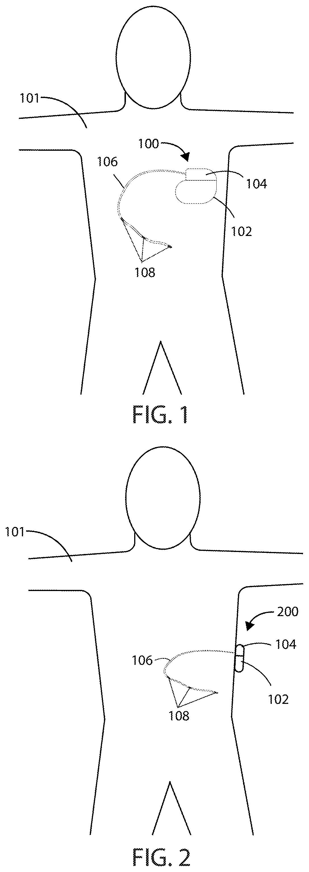 Patent US12403306 Figure 1 – Electric field shaping leads for treatment of cancer