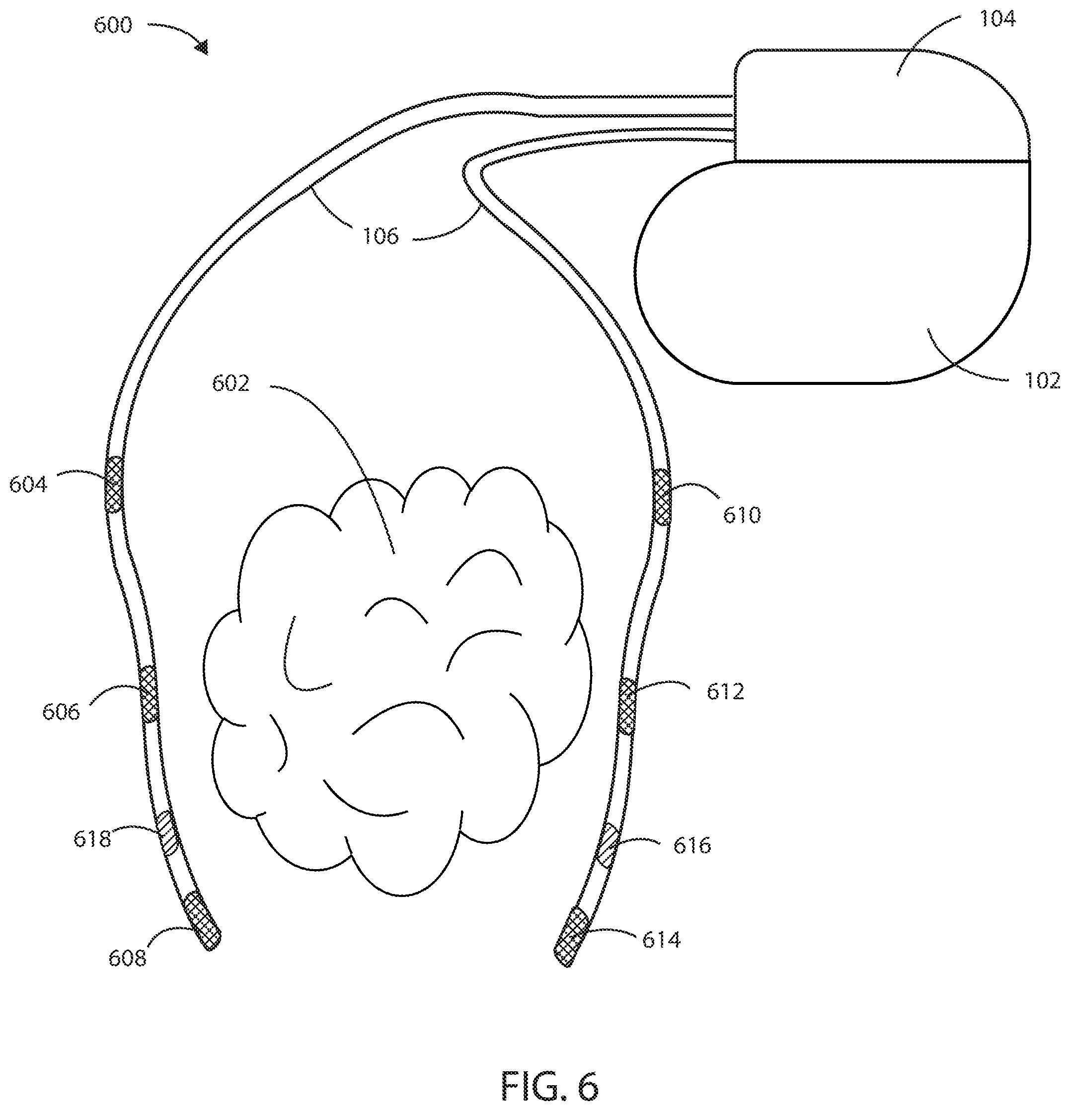 Patent US12403306 Figure 4 – Electric field shaping leads for treatment of cancer
