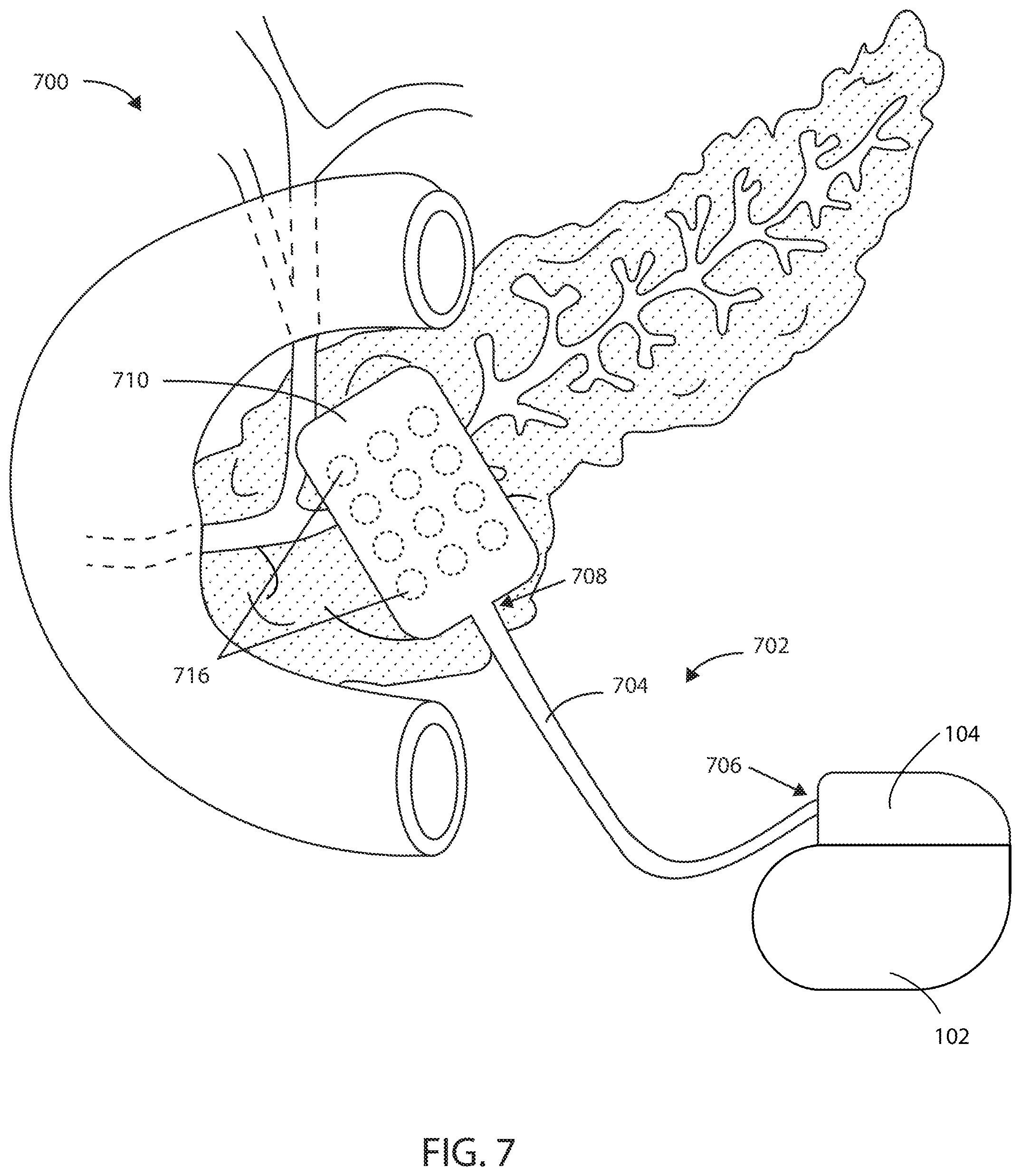 Patent US12403306 Figure 5 – Electric field shaping leads for treatment of cancer