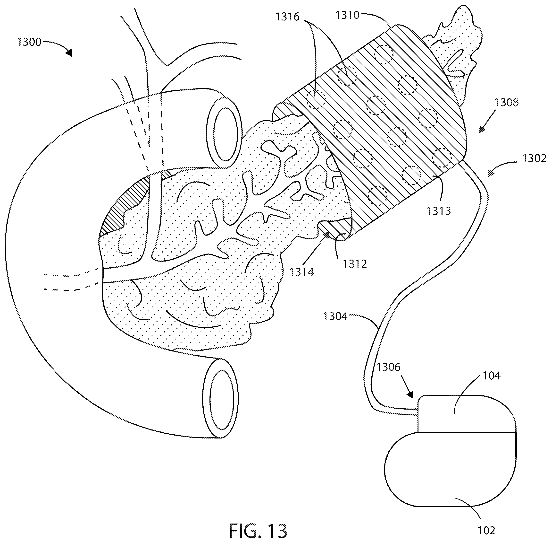 Patent US12403306 Figure 9 – Electric field shaping leads for treatment of cancer