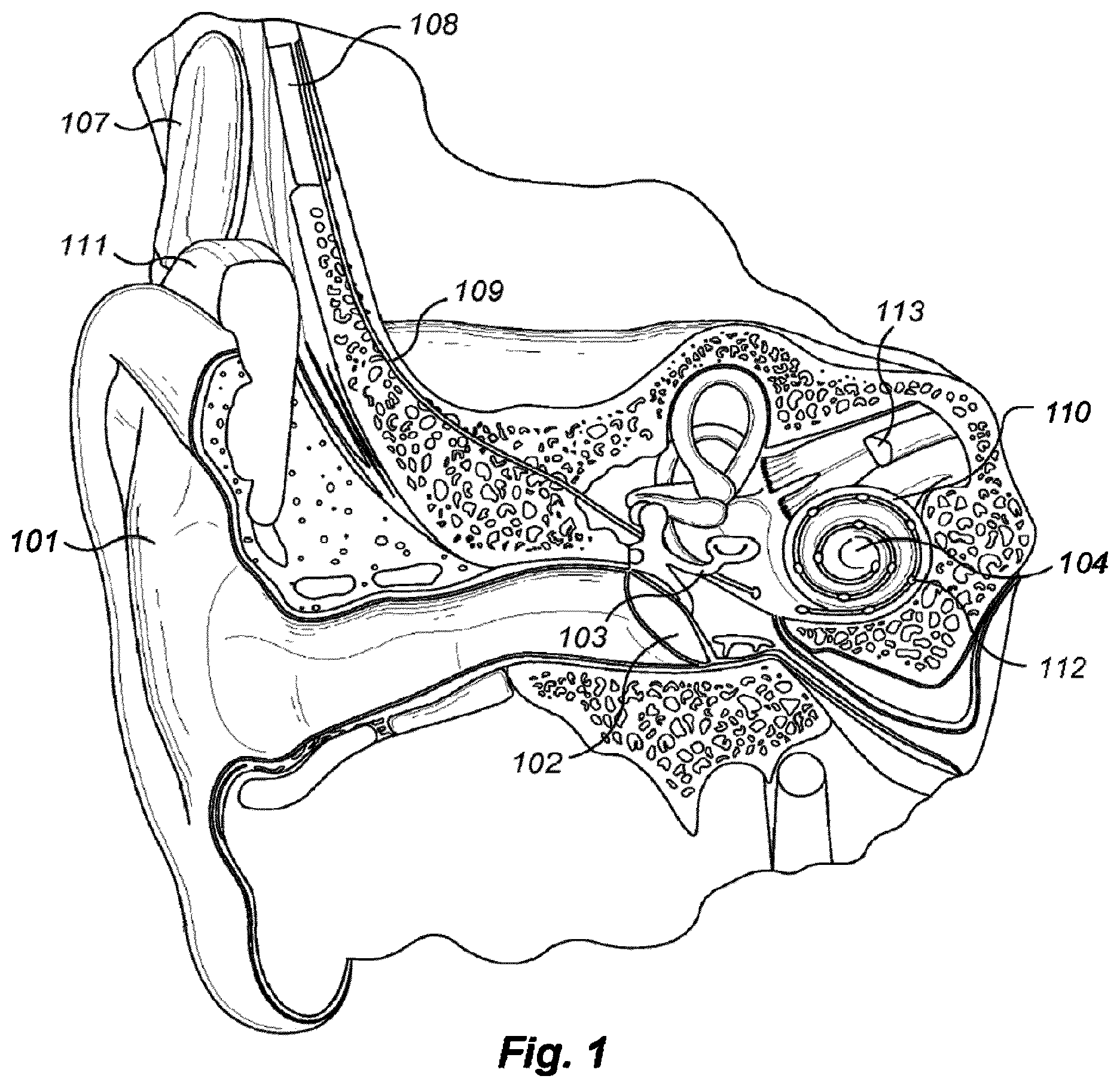 Patent US12403310 Figure 1 – Medial olivocochlear reflex sound coding with bandwidth normalization