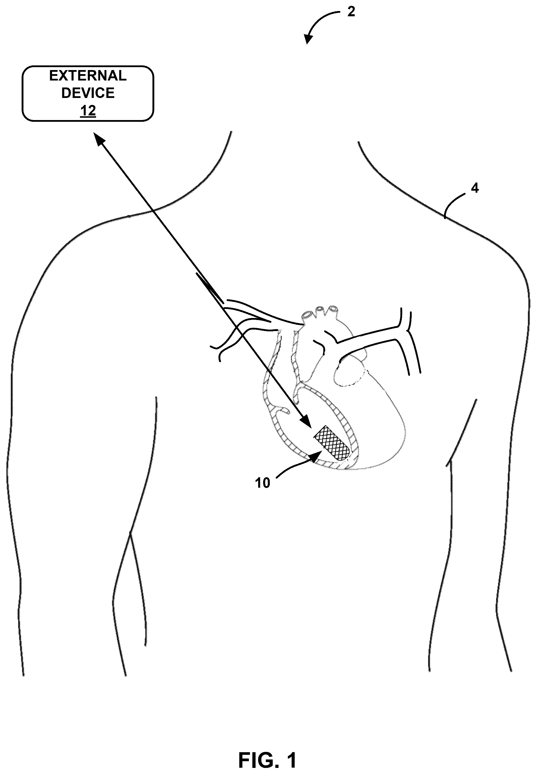 Patent US12403318 Figure 1 – Ceramic enclosure for rechargeable medical devices