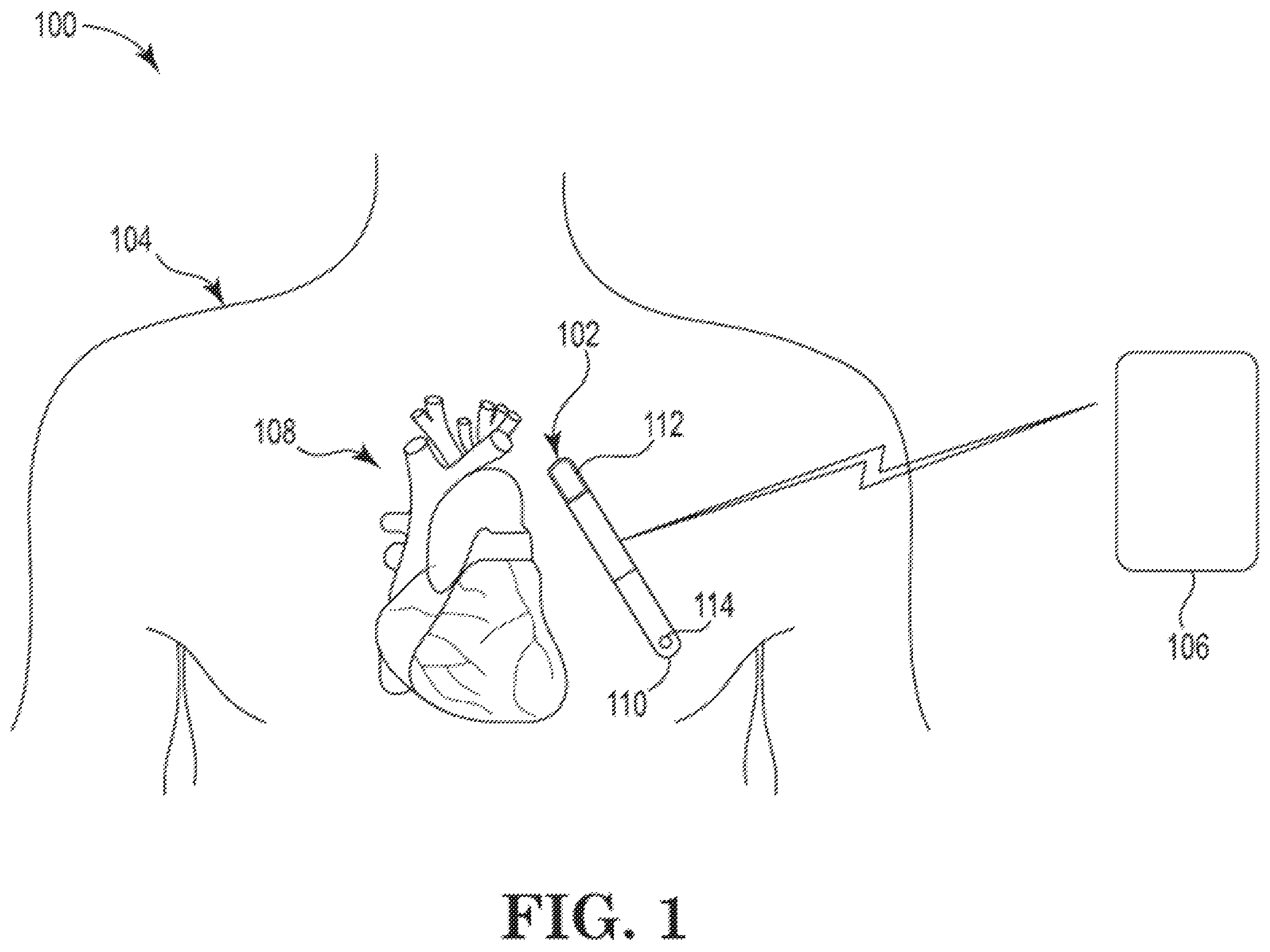 Patent US12403321 Figure 1 – Case driven design for implantable medical device
