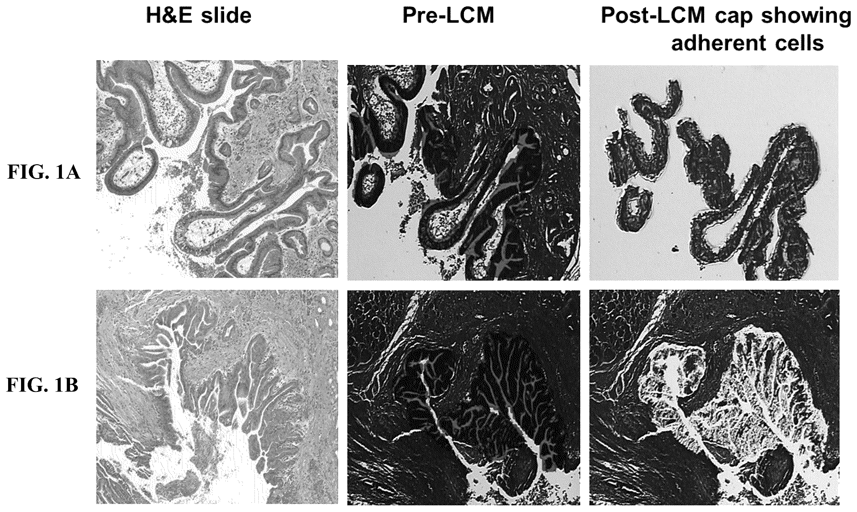 Patent US12410479 Figure 1 – Microrna assay for detection and management of pancreatic cancer precursors