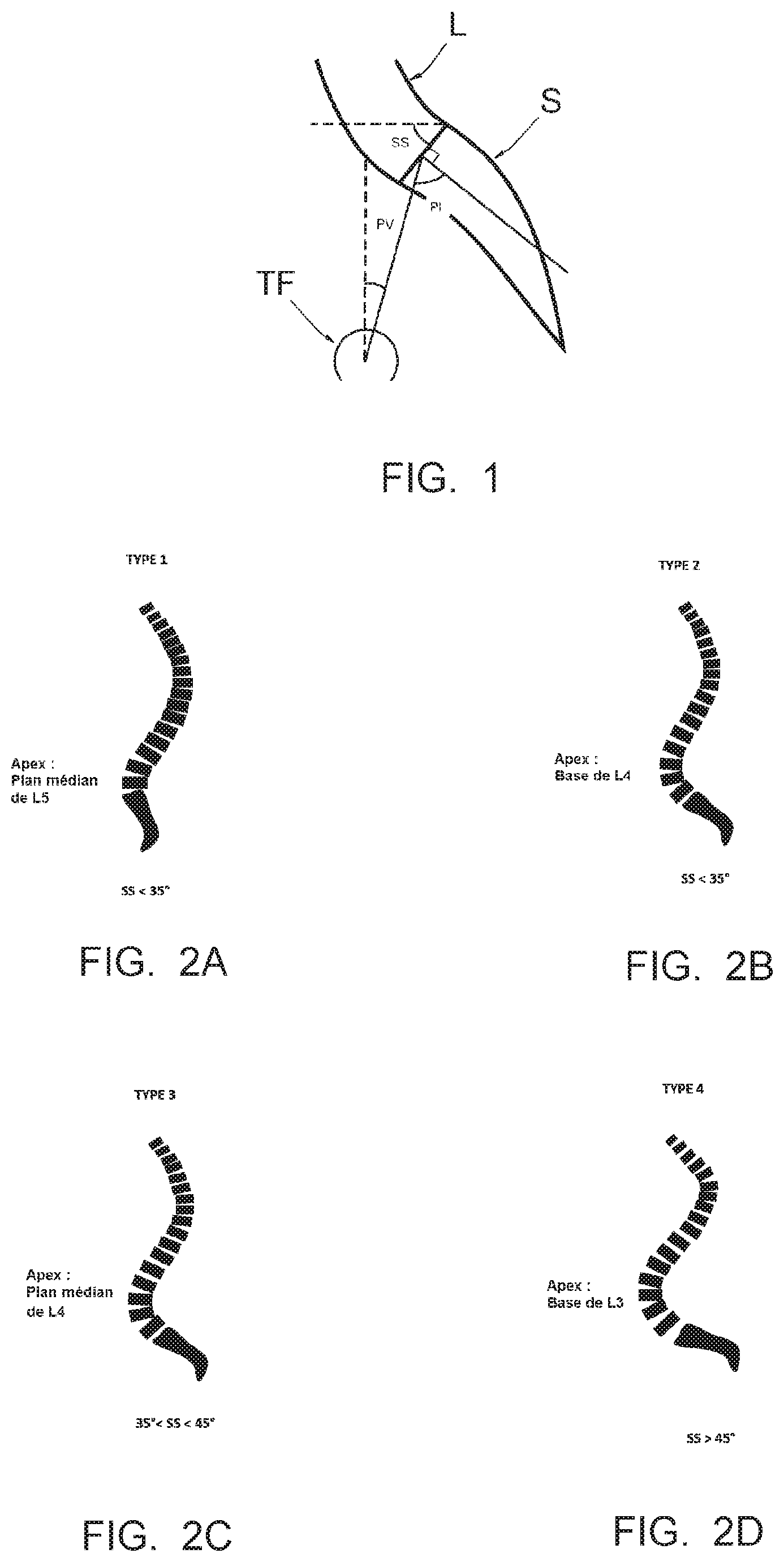 Patent US12417323 Figure 1 – Method of making it possible to produce and ideal curvature of a rod of vertebral osteosynthesis material designed to support a patient's vertebral column