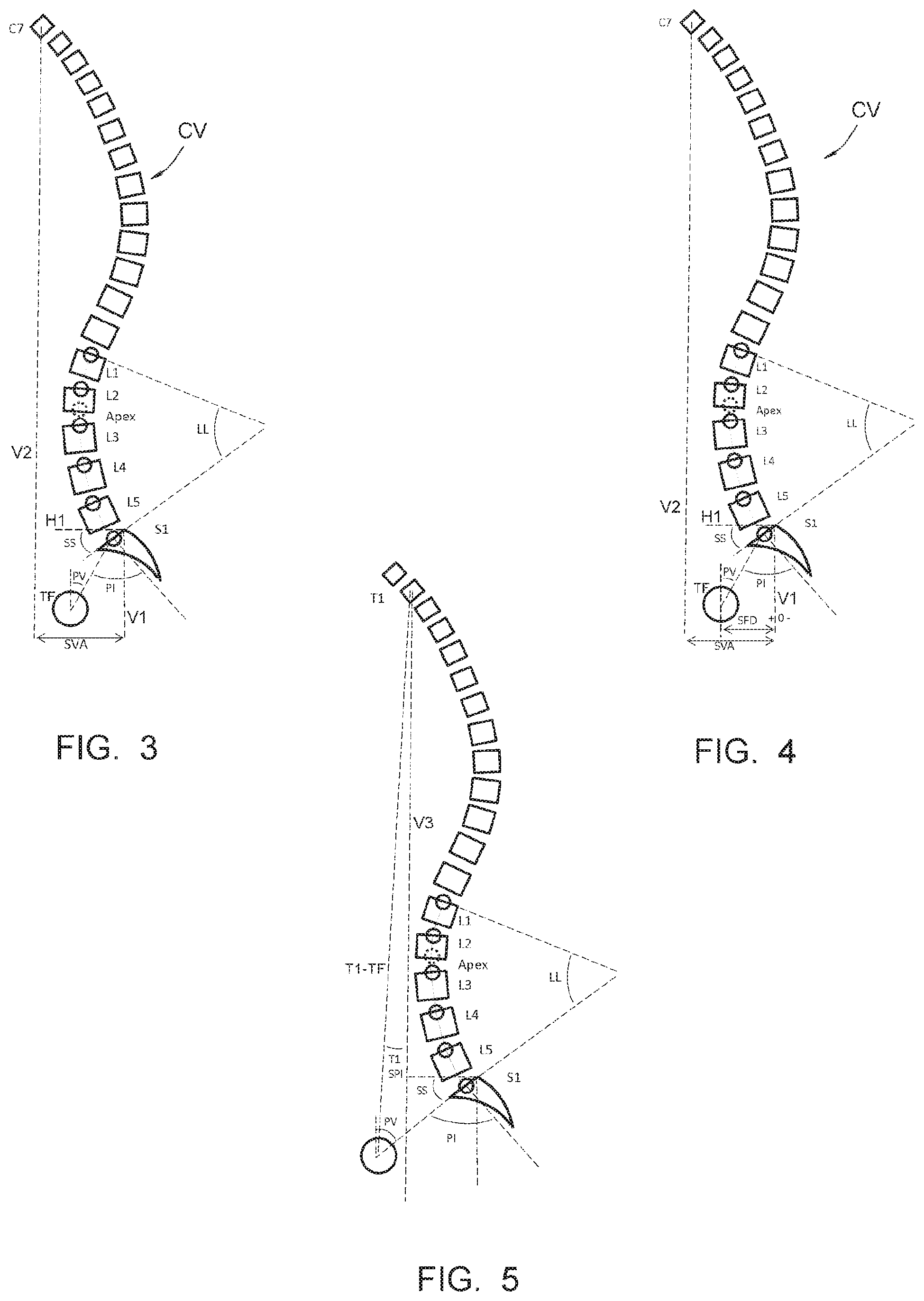 Patent US12417323 Figure 2 – Method of making it possible to produce and ideal curvature of a rod of vertebral osteosynthesis material designed to support a patient's vertebral column