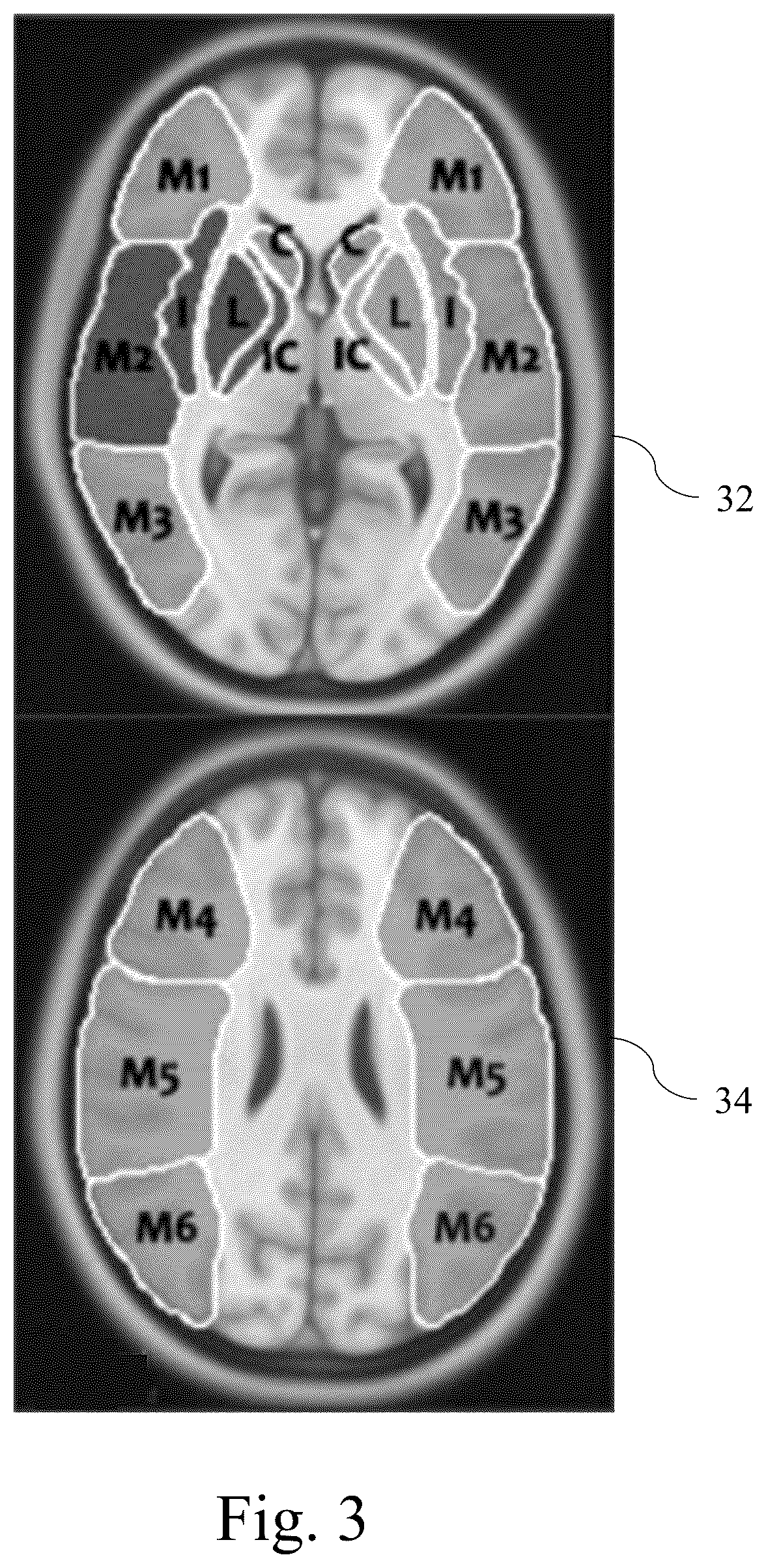 Patent US12417536 Figure 3 – Automated detection system for acute ischemic stroke
